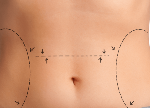 Fat Reduction with No Surgery? CUT IT OUT!