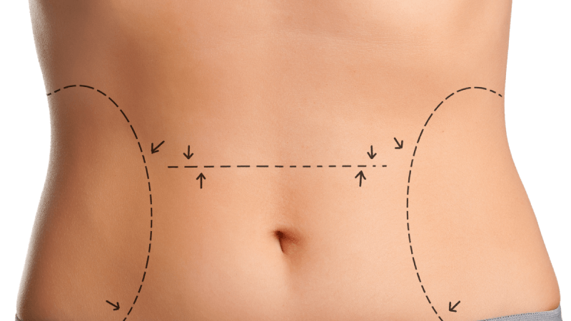Fat Reduction with No Surgery? CUT IT OUT!