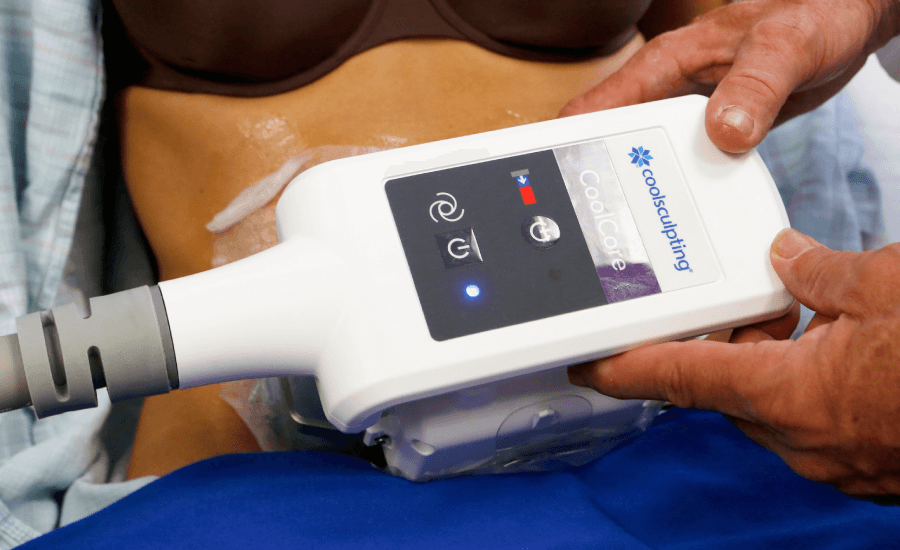 CoolSculpting machine on stomach