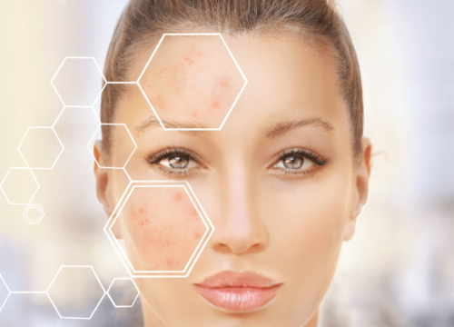 Different Types of Acne Scars and How to Treat Them