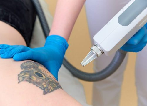 Everything You Need to Know About Tattoo Removal Aftercare