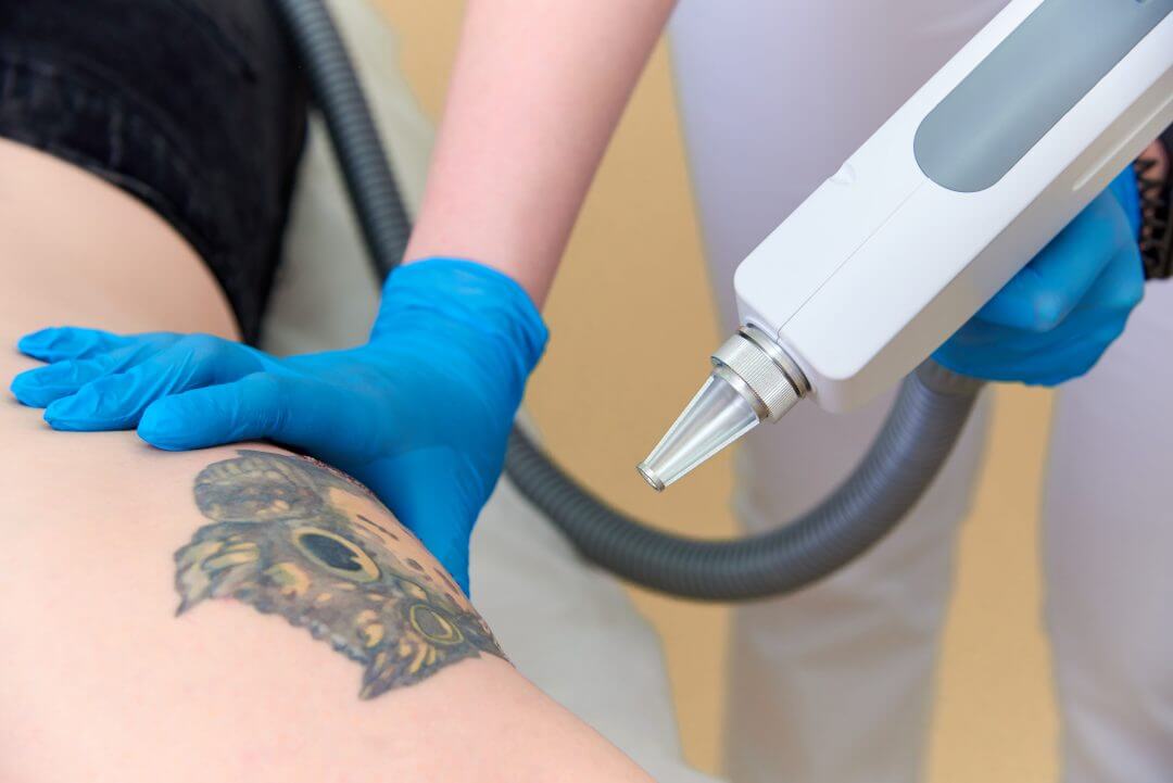 Everything You Need to Know About Tattoo Removal Aftercare | Skin MD Laser  & Cosmetic Group