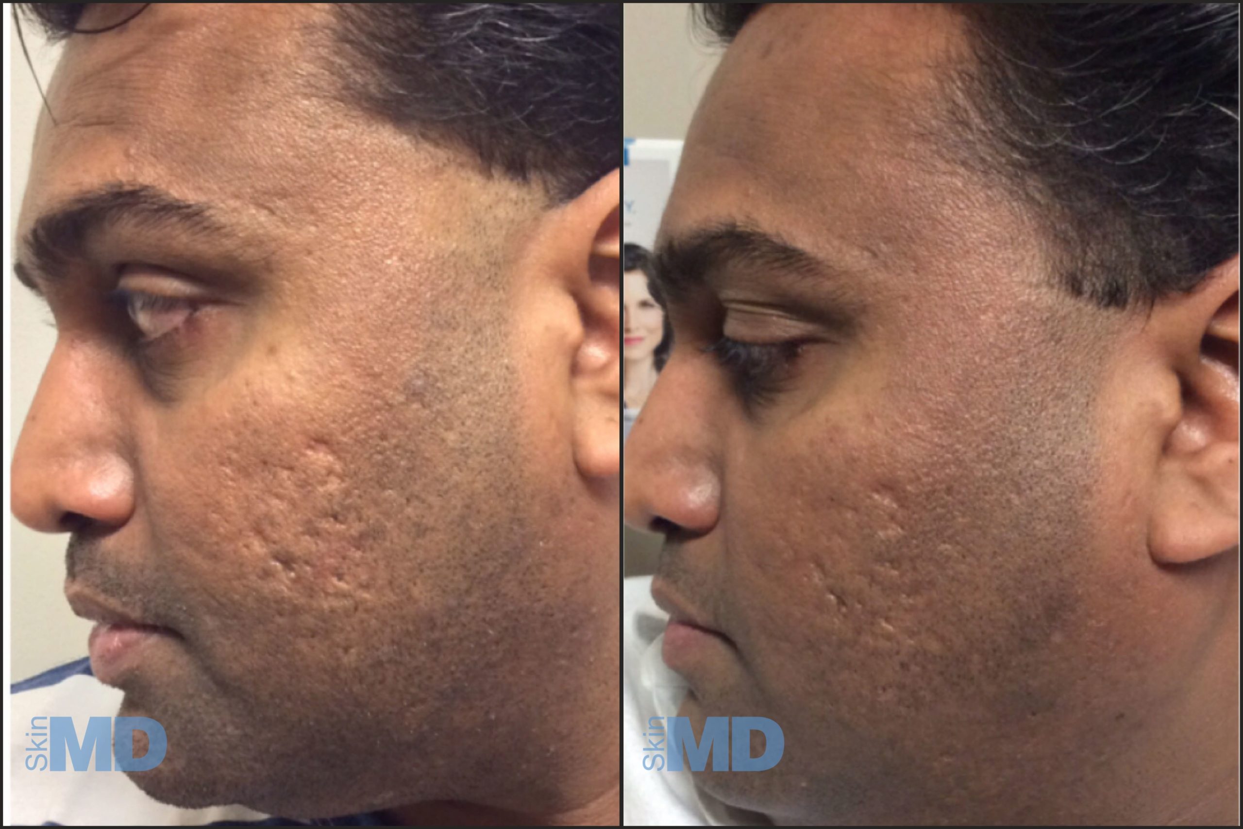 Before and after 1540 treatments