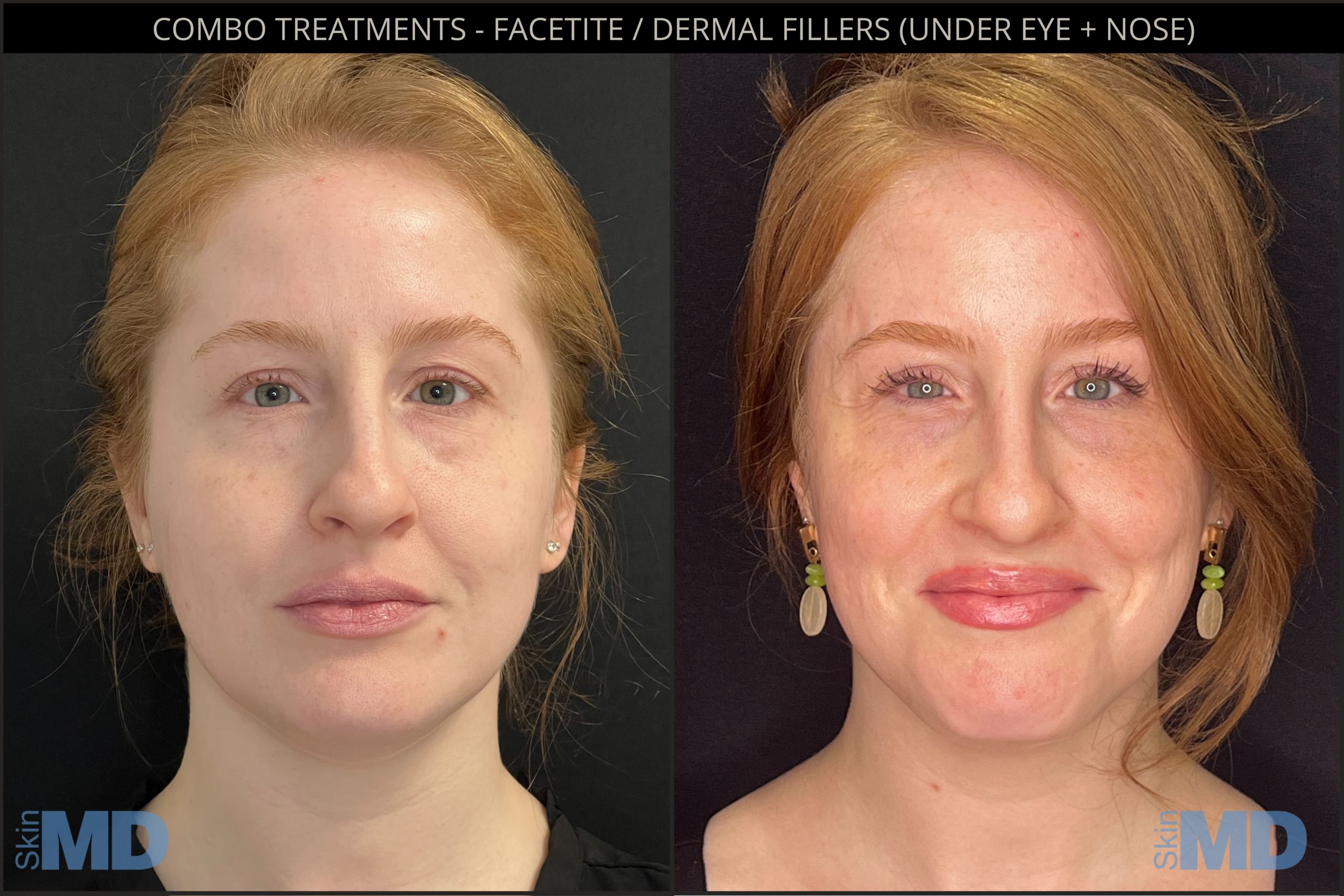 Before and after combo treatments results