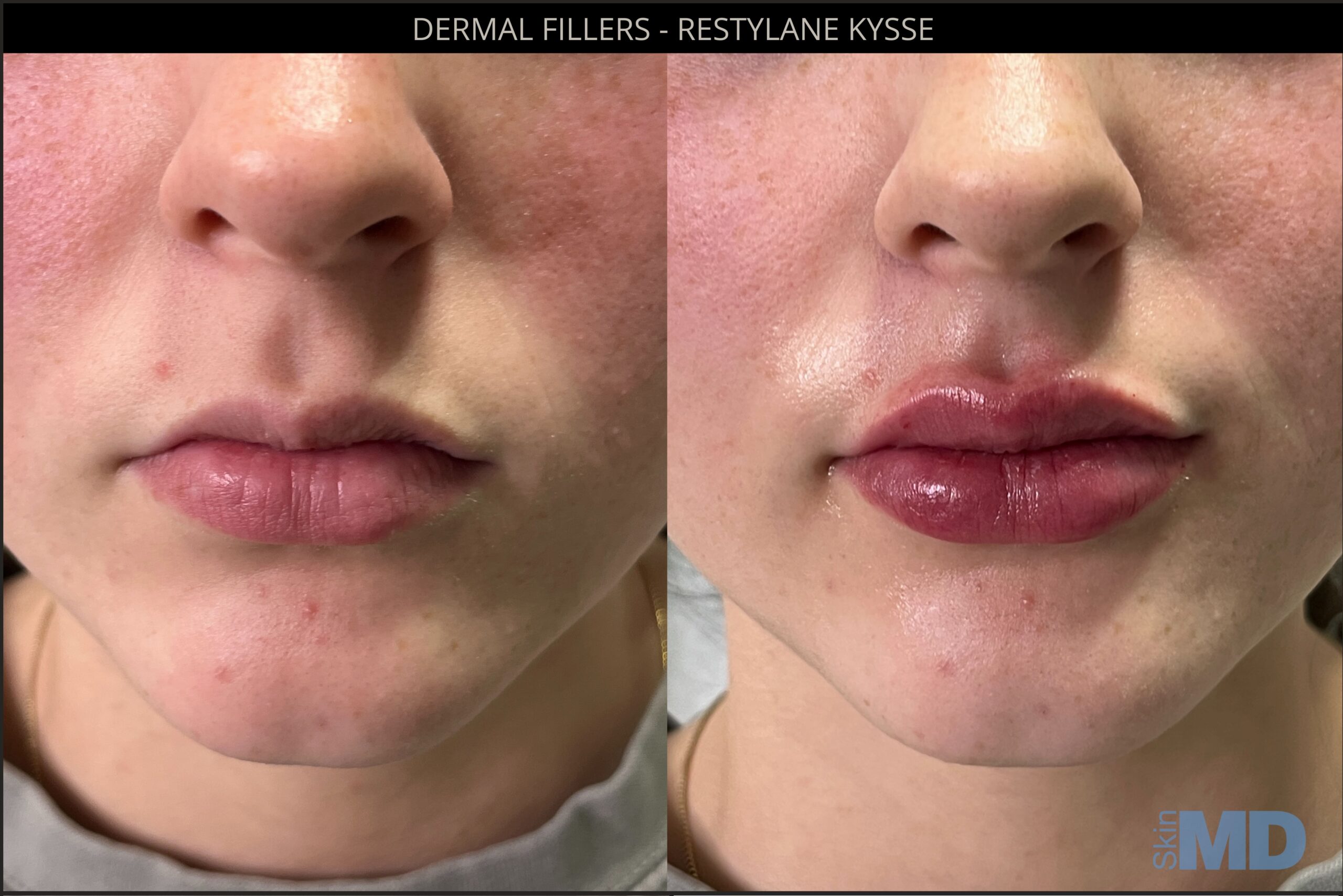 Before and after dermal filler results