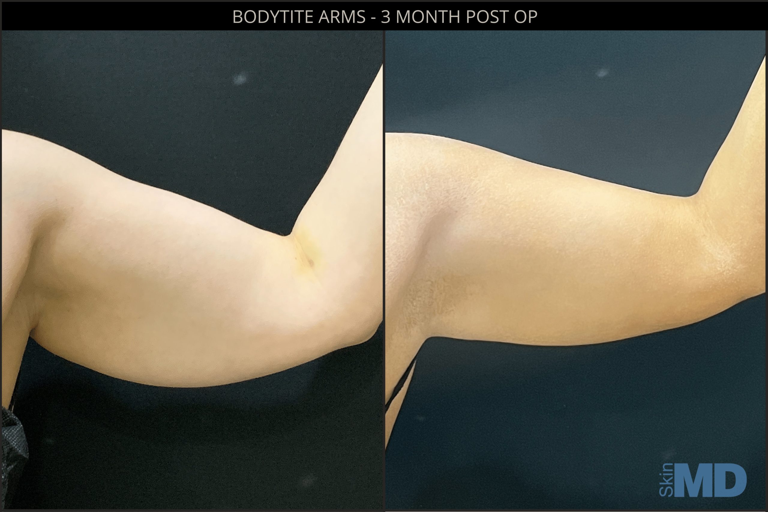 Before and after BodyTite results
