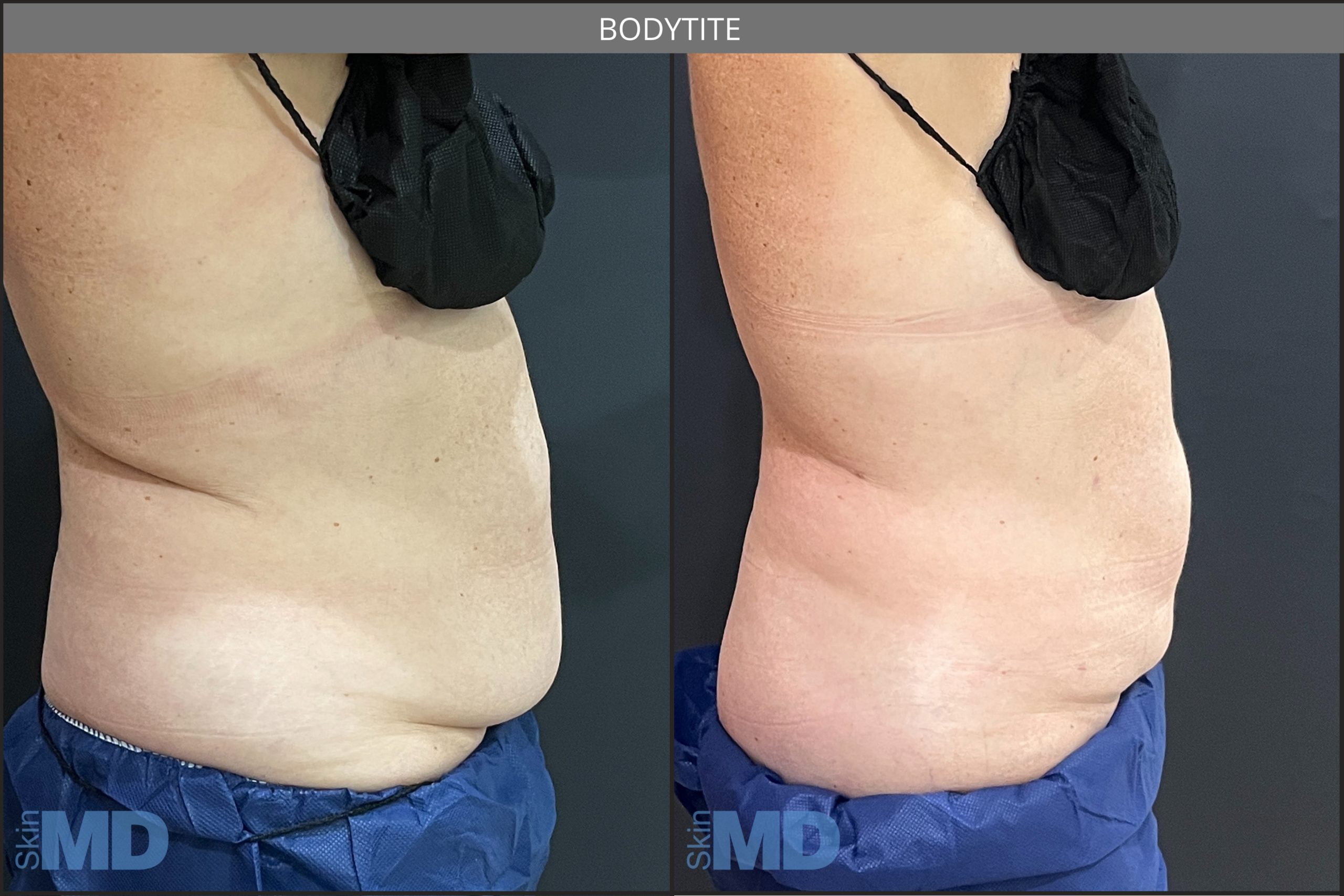 Before and after BodyTite results
