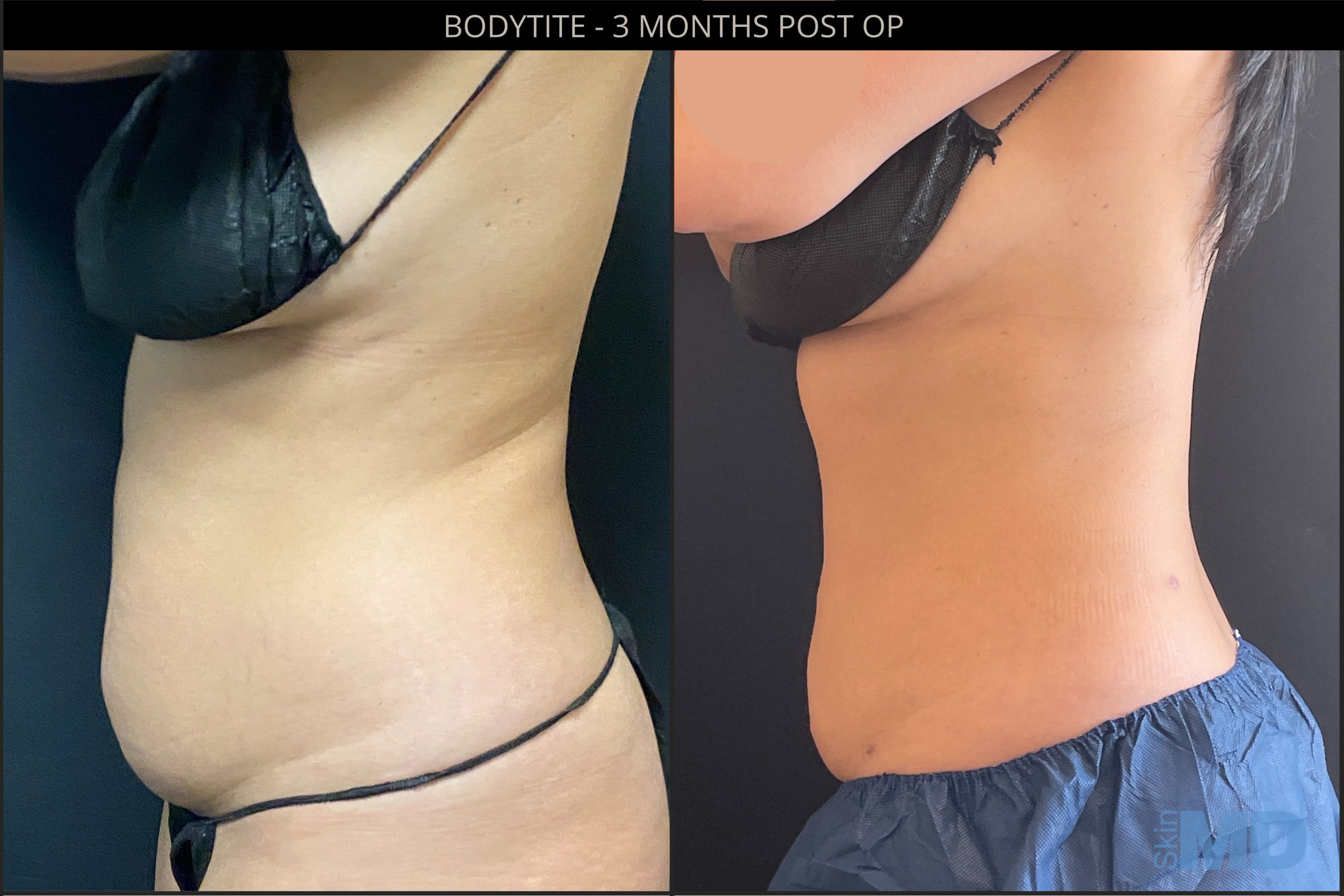Before and after BodyTIte results