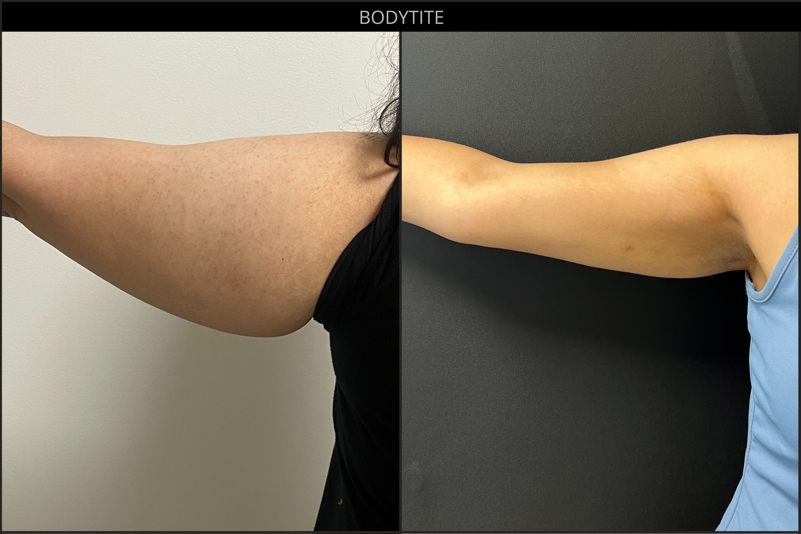 Before and after BodyTite arm results
