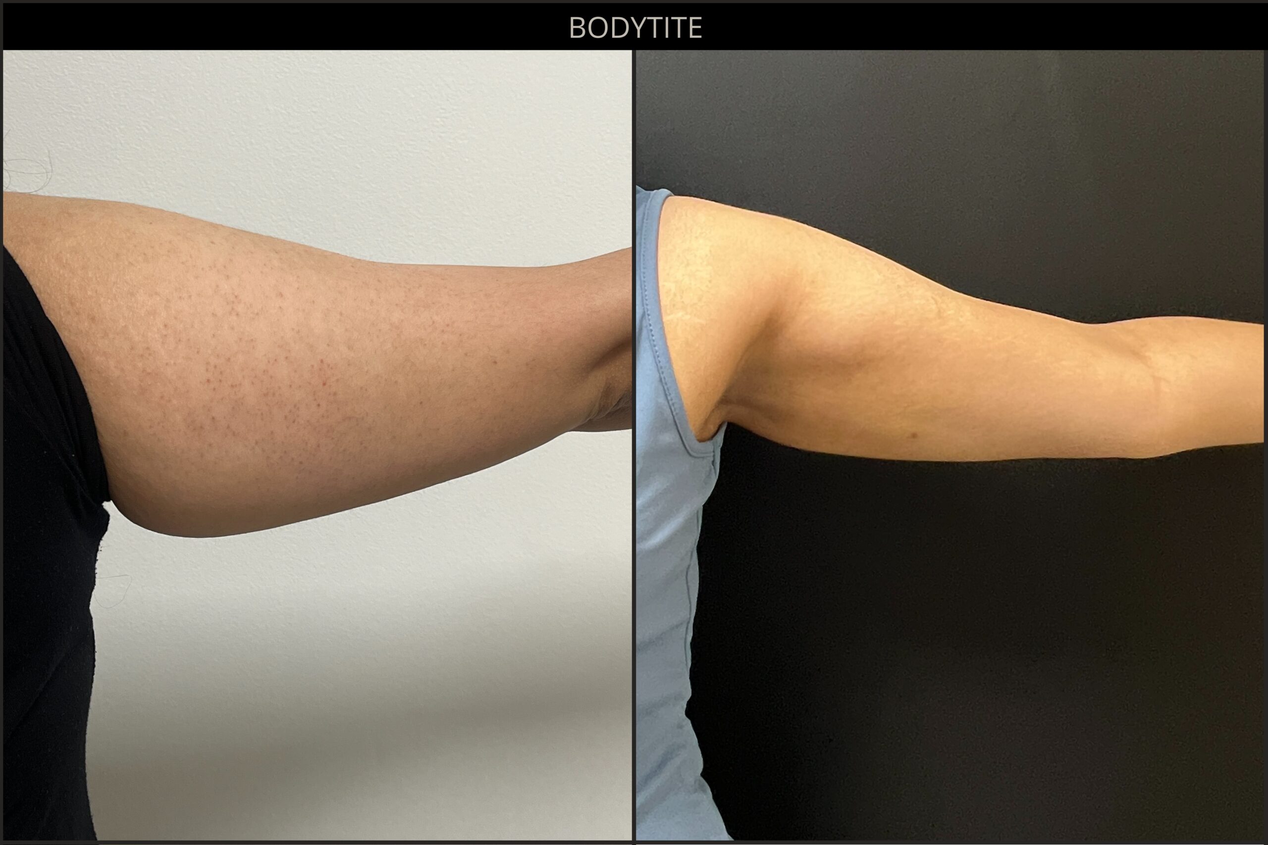 Before and after BodyTite arm results