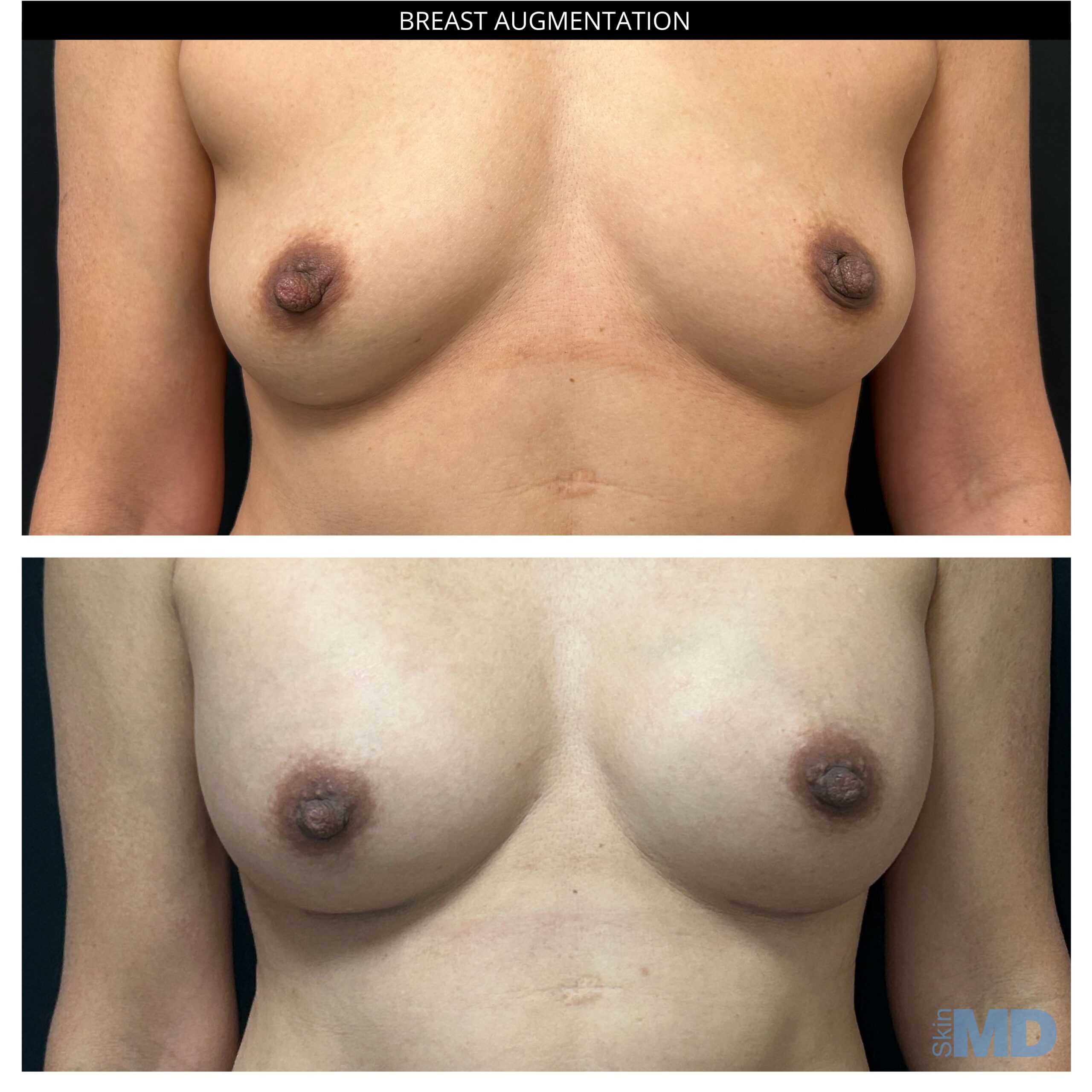 Before and after breast augmentation results