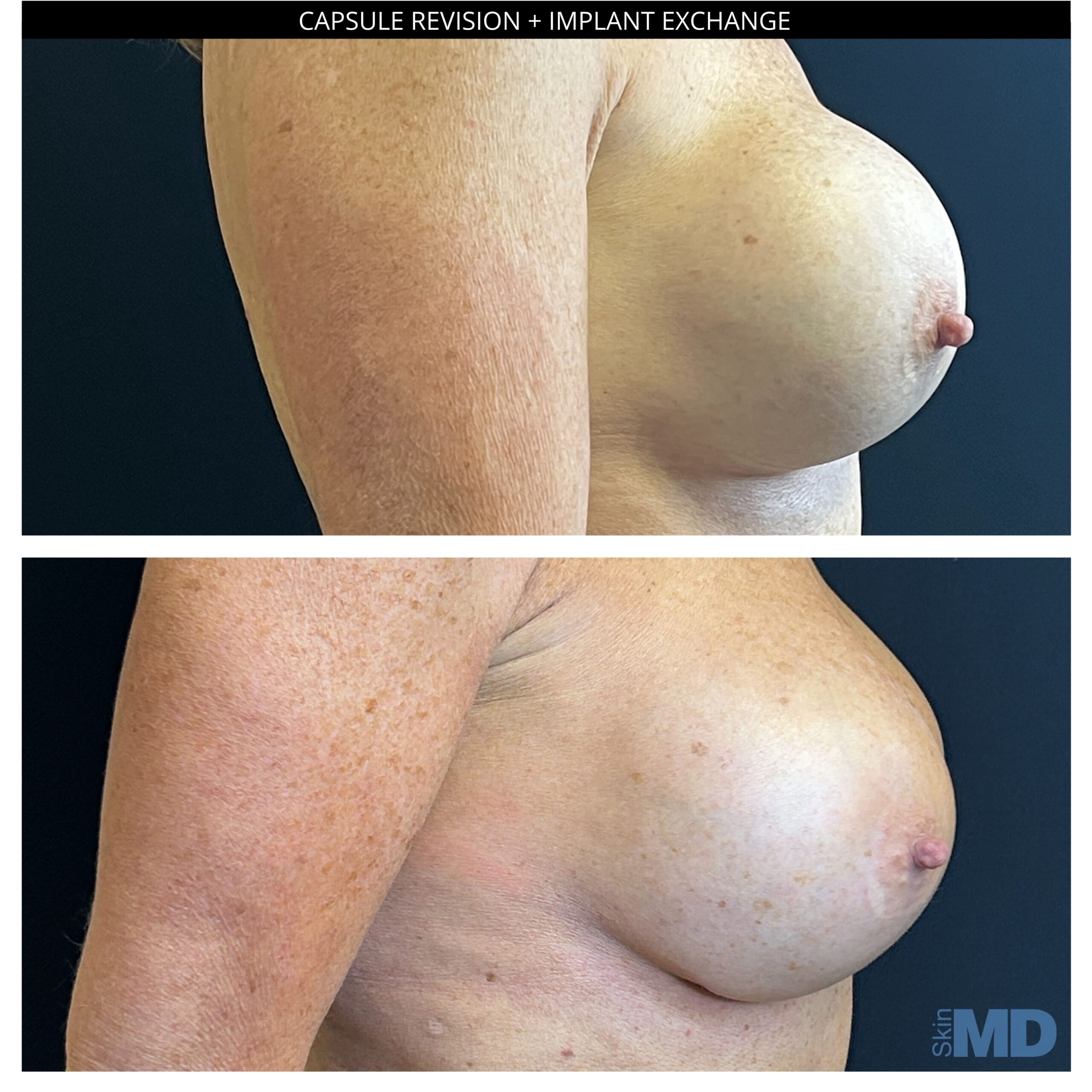 Before and after breast reduction results
