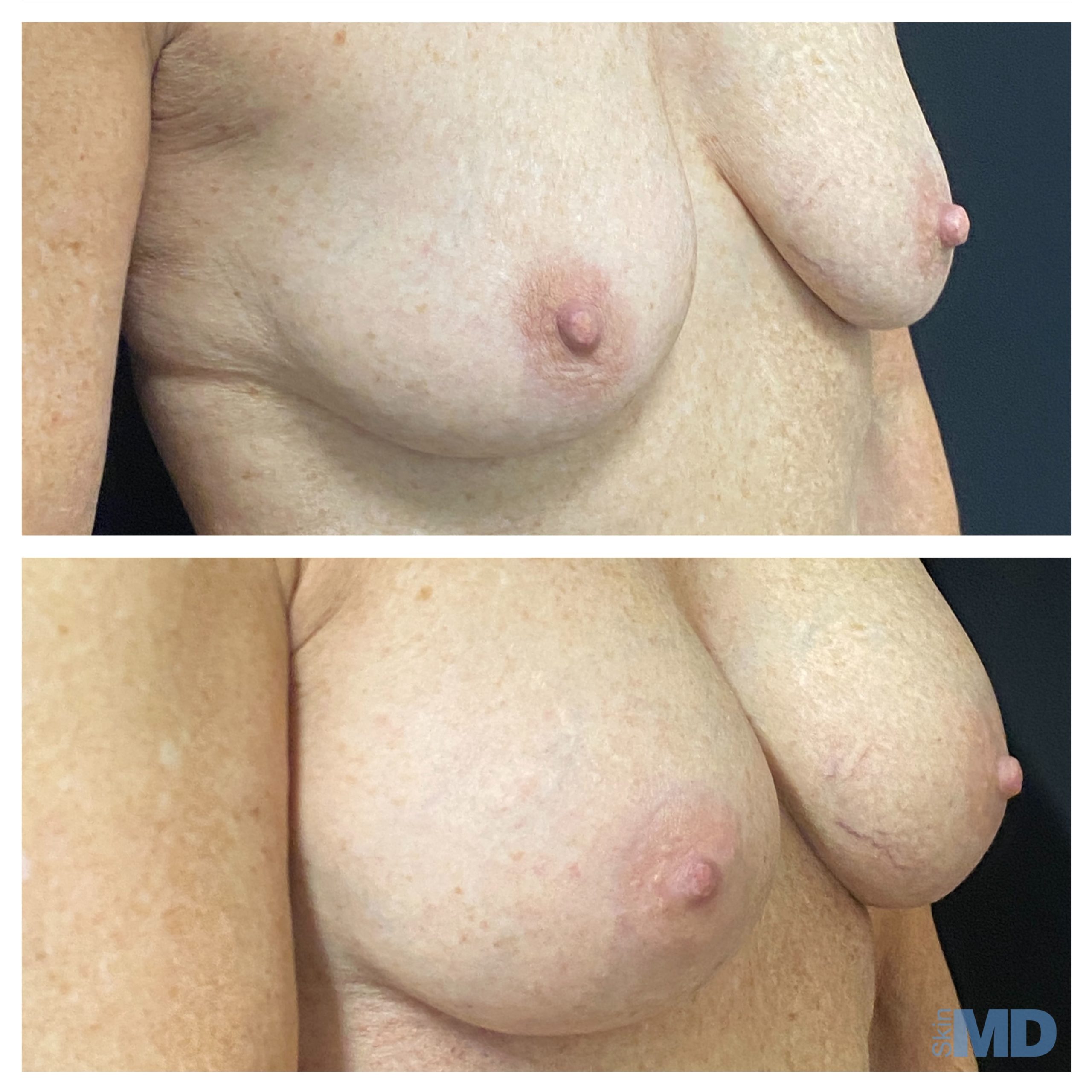 Before and after breast augmentation results