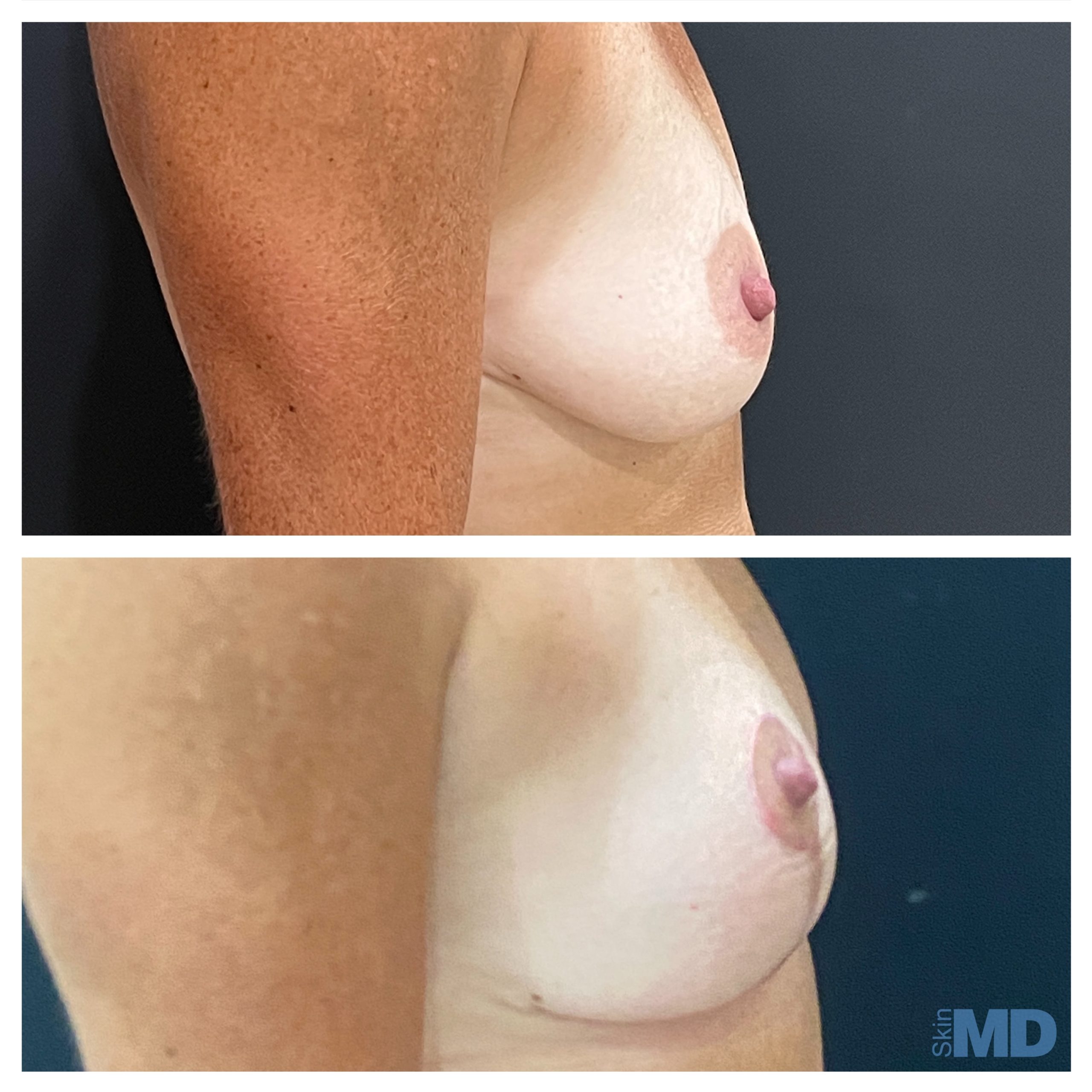 Before and after Breast Lift results