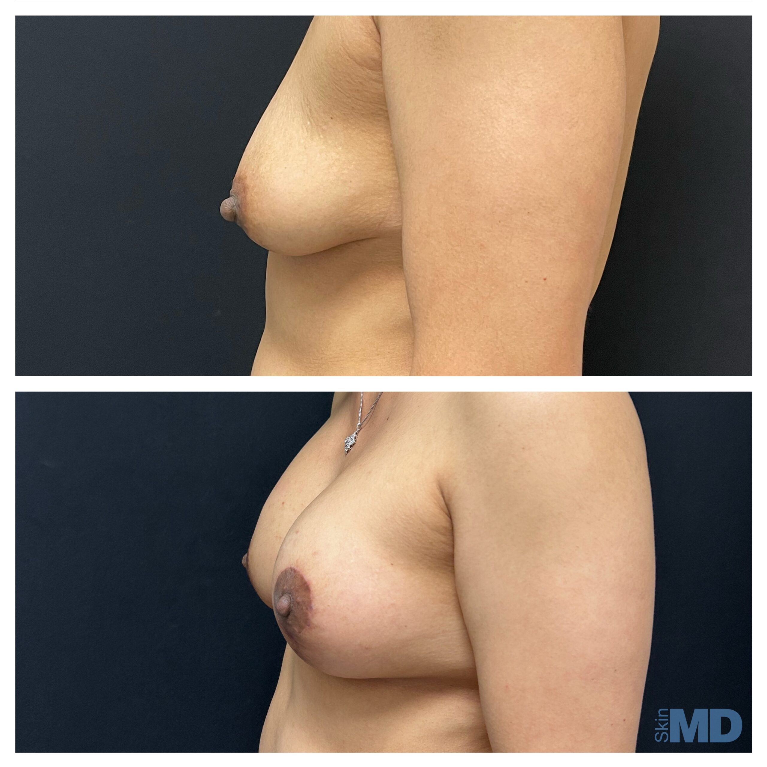 Before and after breast lift results