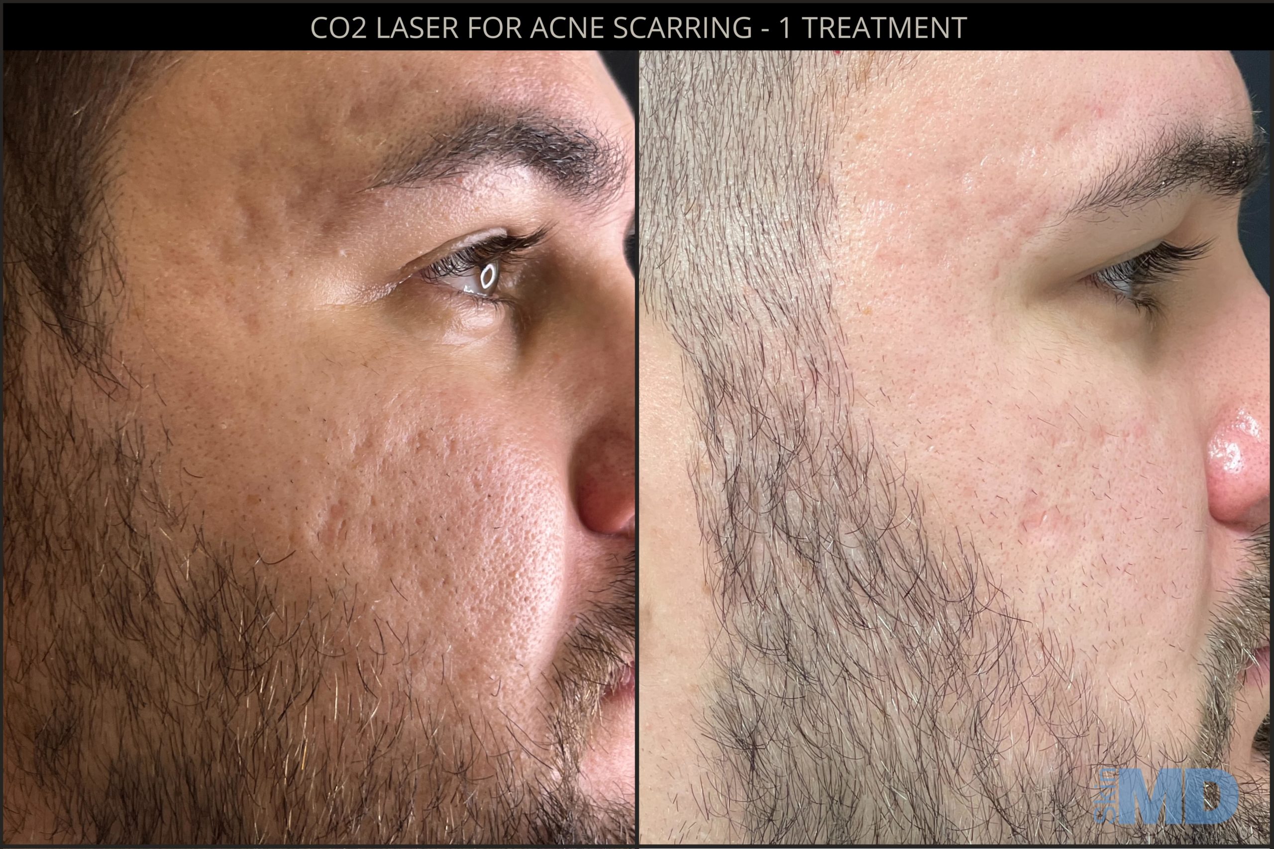 Radar Stromspannung Hilflosigkeit Co2re Laser Treatment Schlecht 