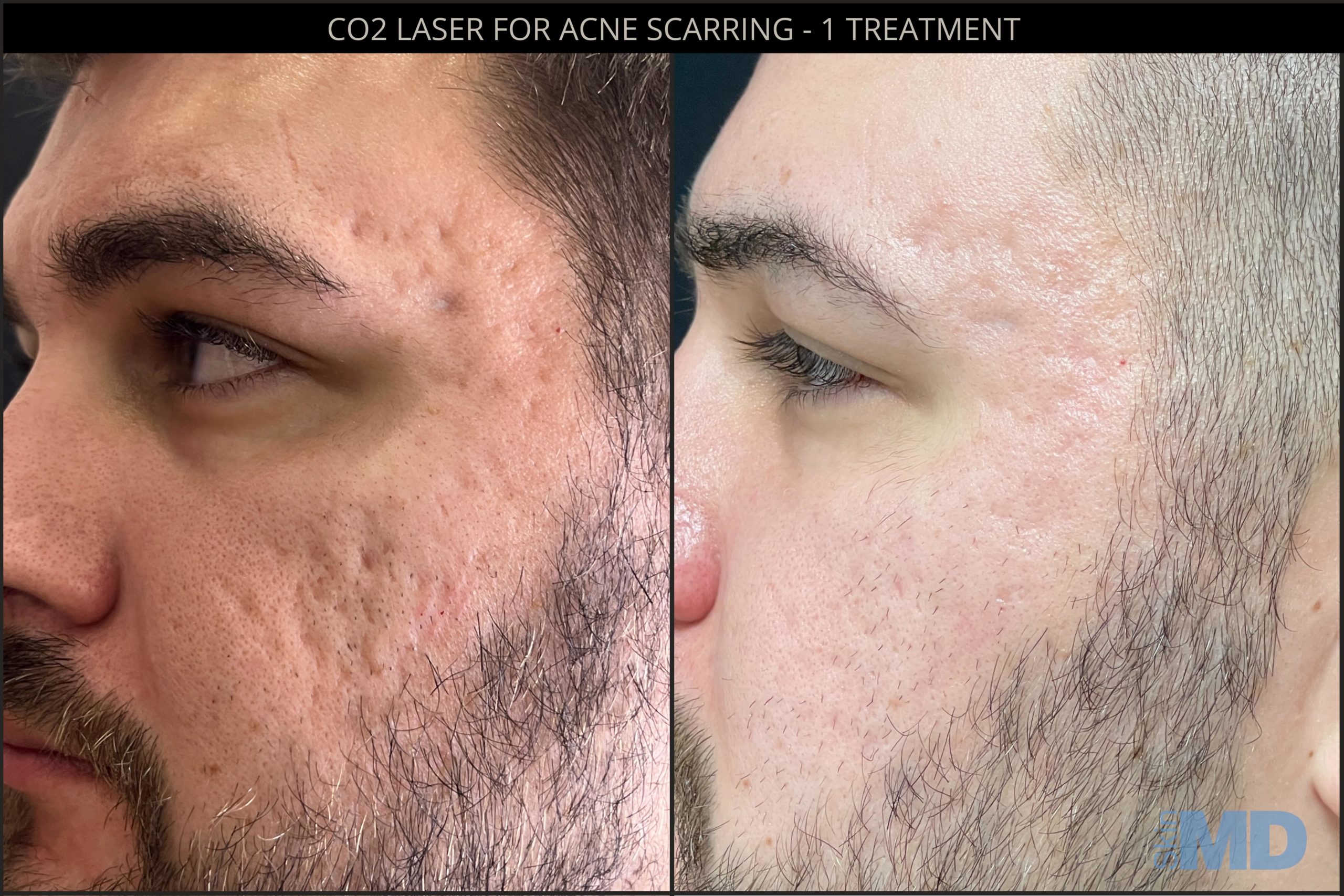 Before and after CO2 laser resurfacing results