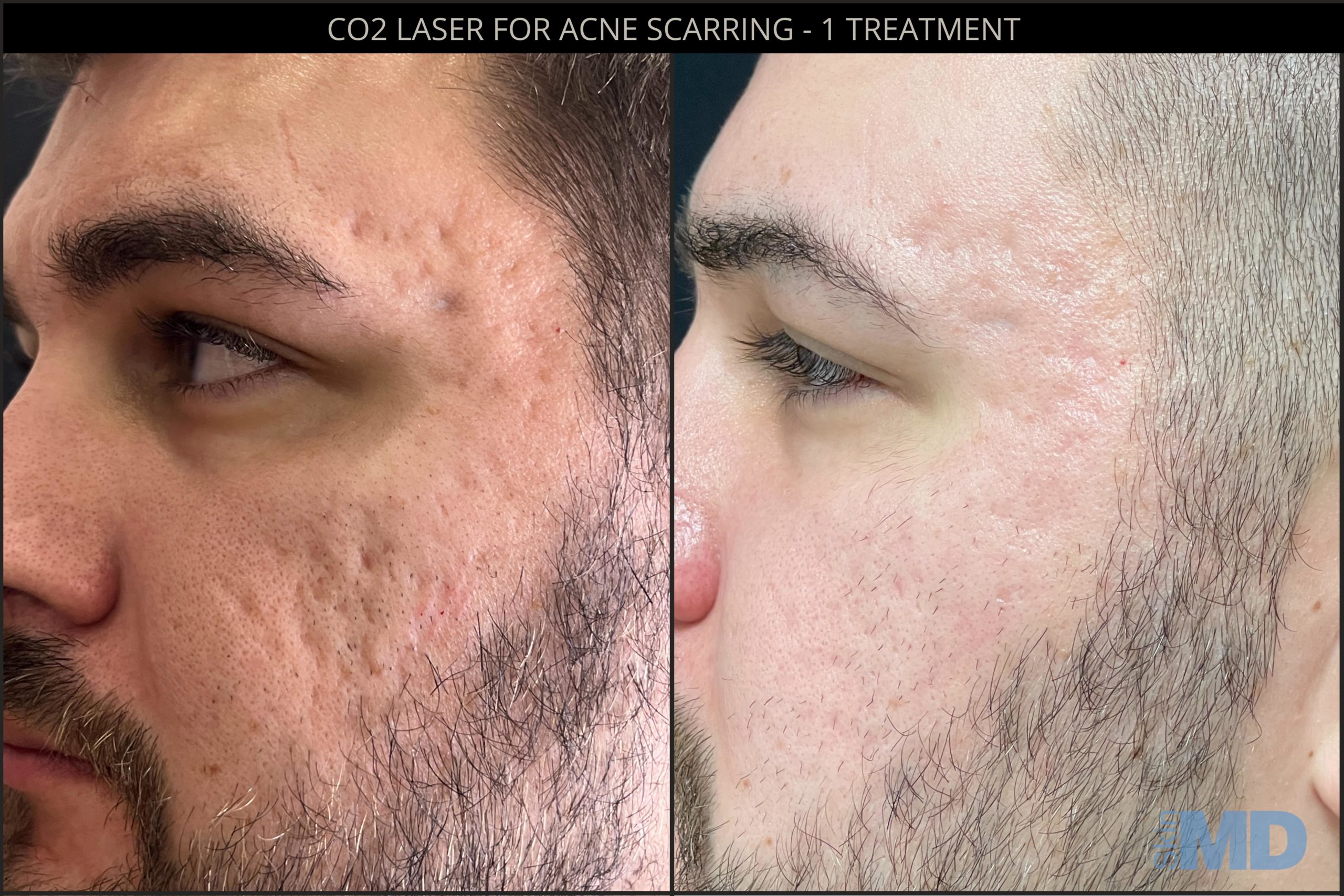 CO2 LASER TREATMENT BEFORE & AFTER PHOTOS