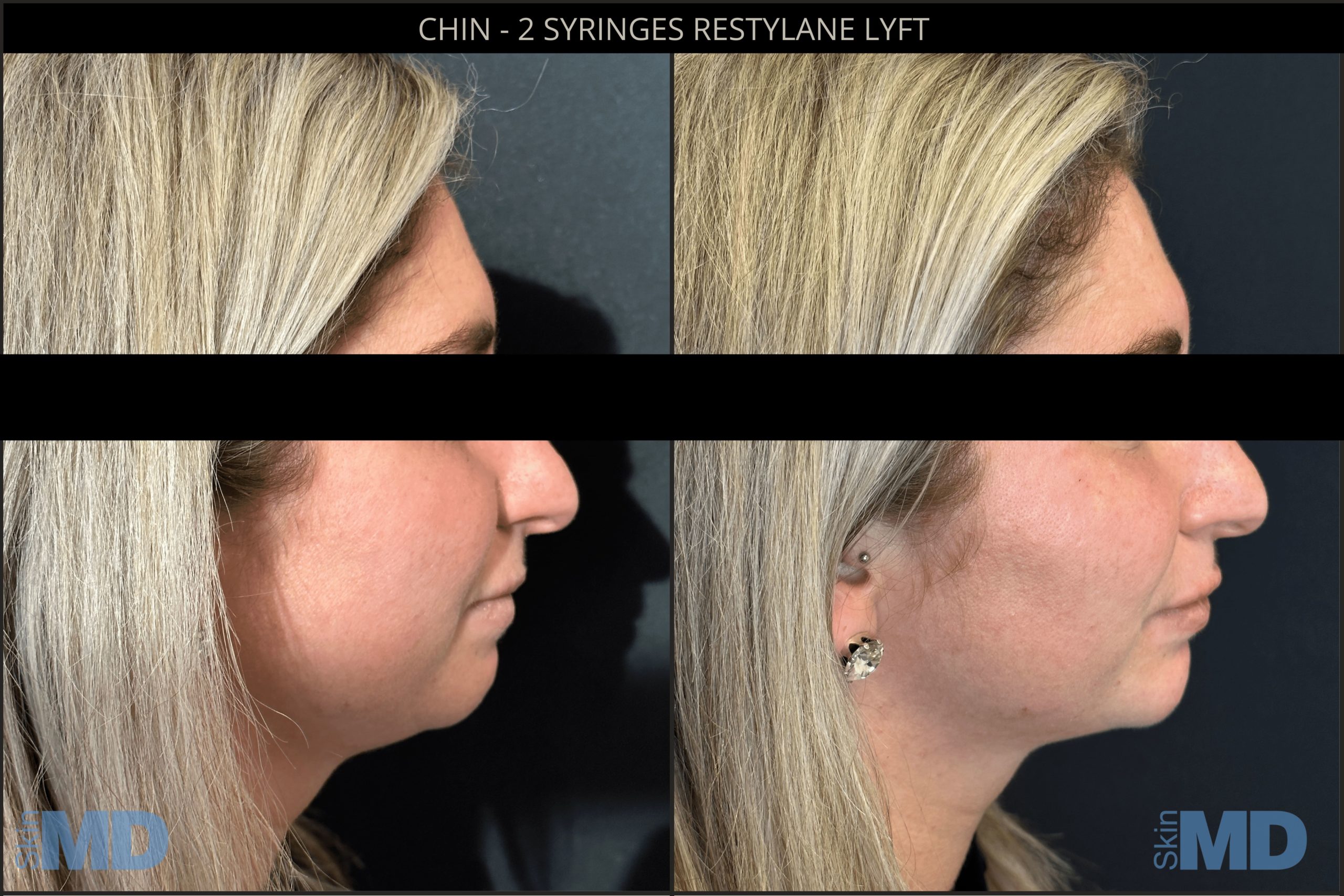 Before and after dermal fillers results
