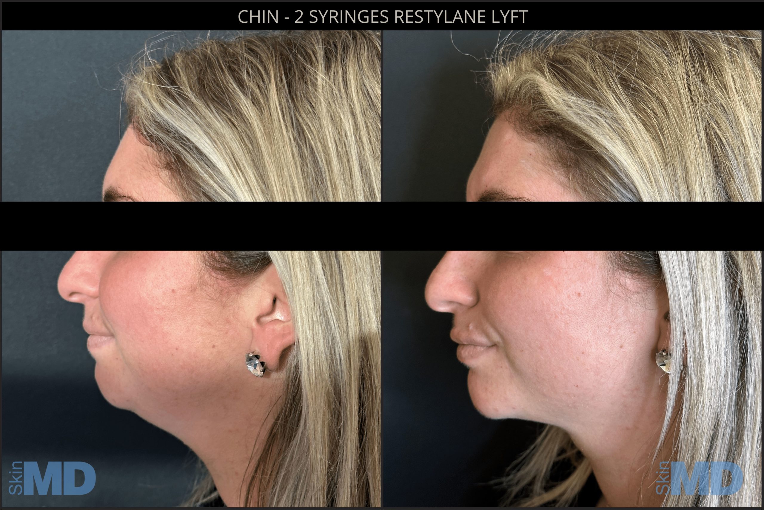 Before and after dermal fillers results