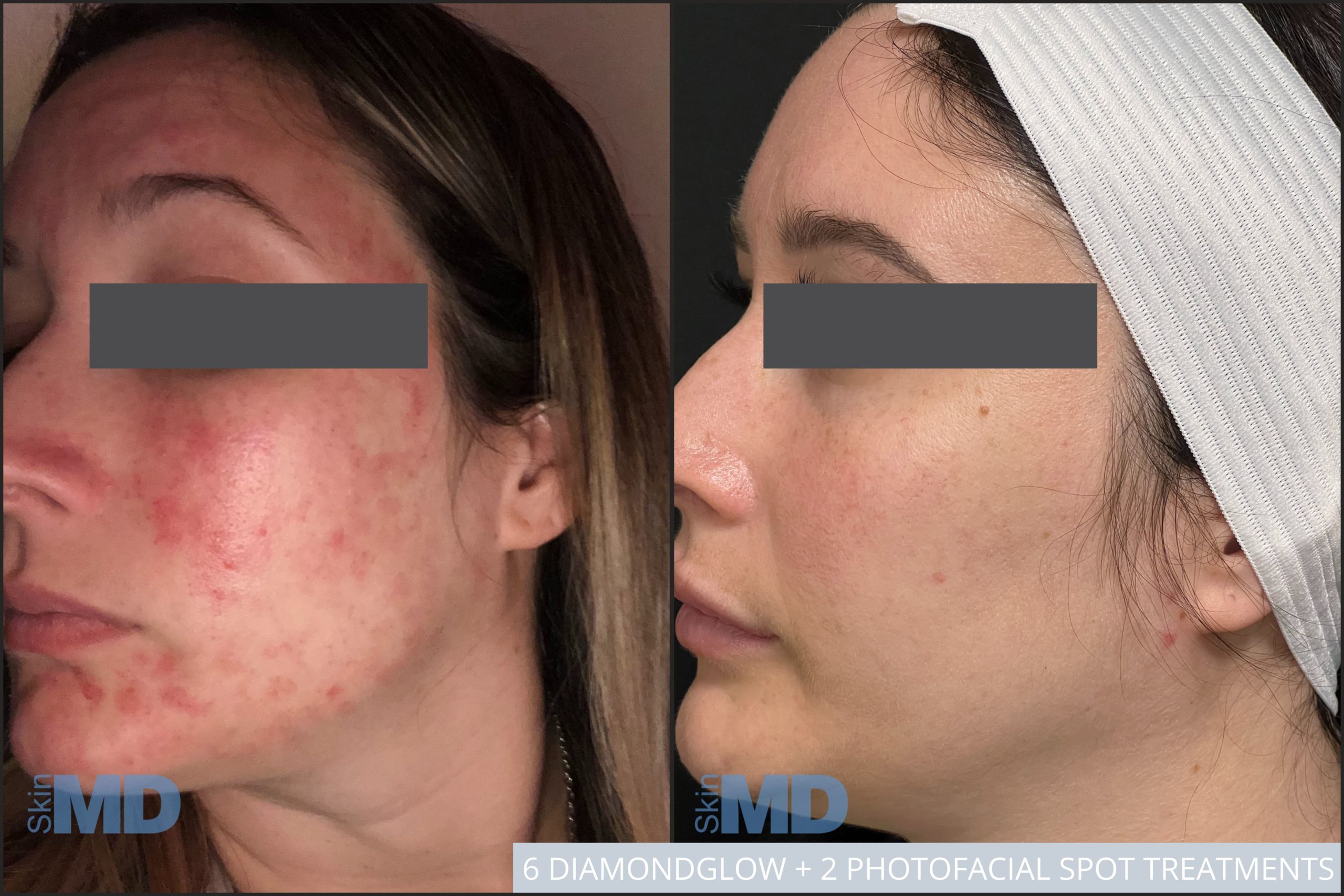Before and after combo treatments results