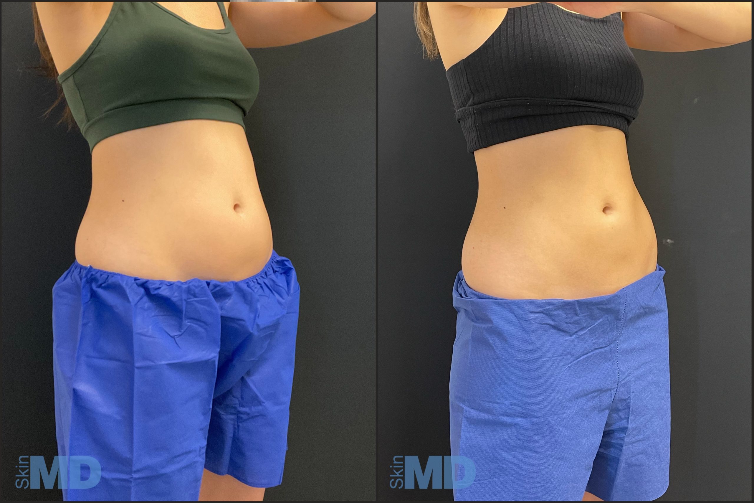 10 Benefits Of Coolsculpting A Reliable Fat freezing Treatment