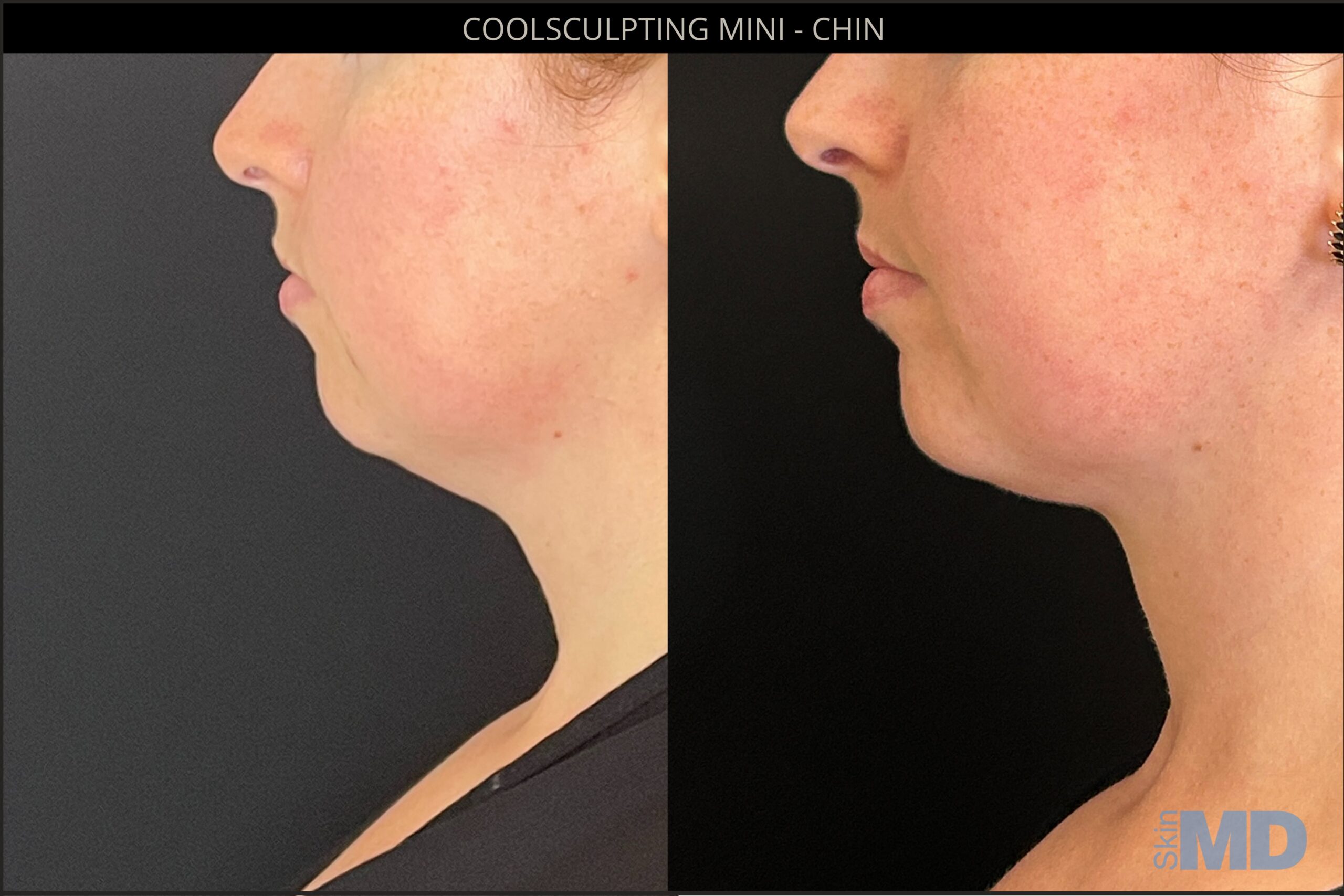 Before and after CoolSculpting mini results