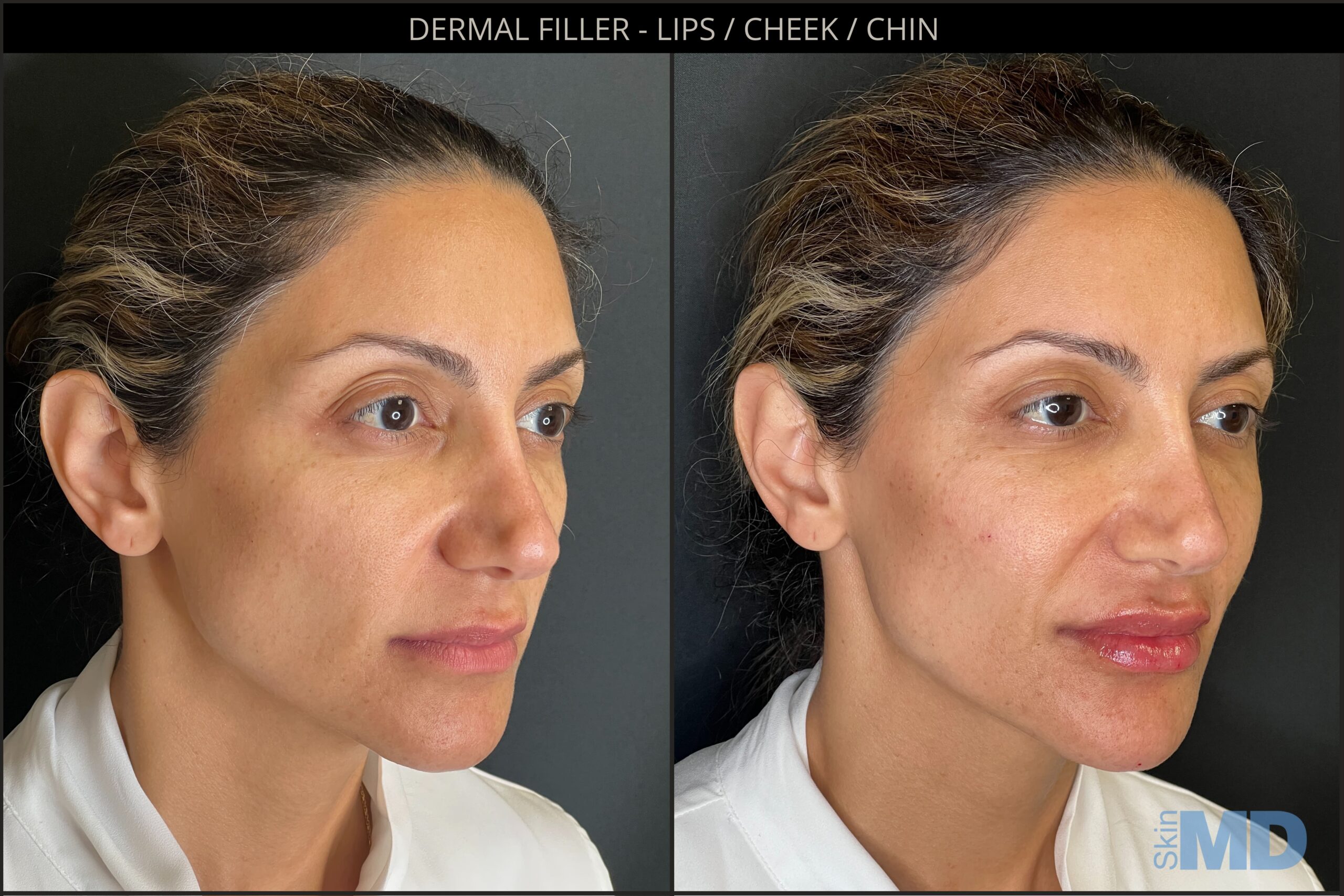 Lip Augmentation Filler