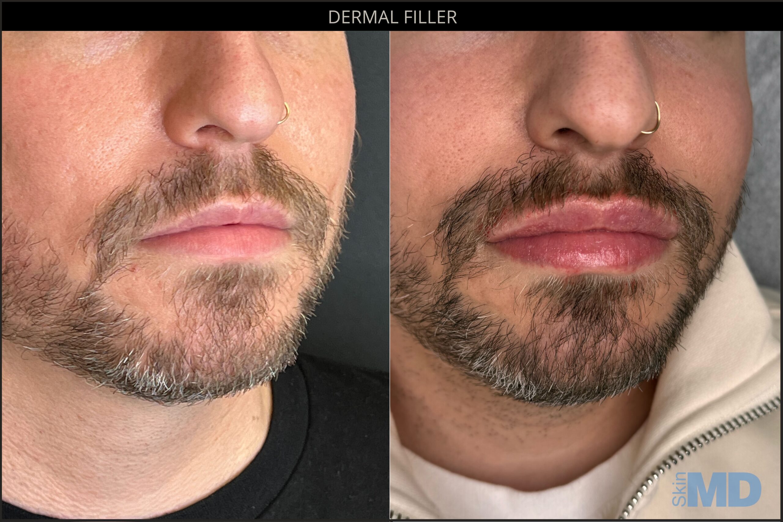 Before and after dermal filler results