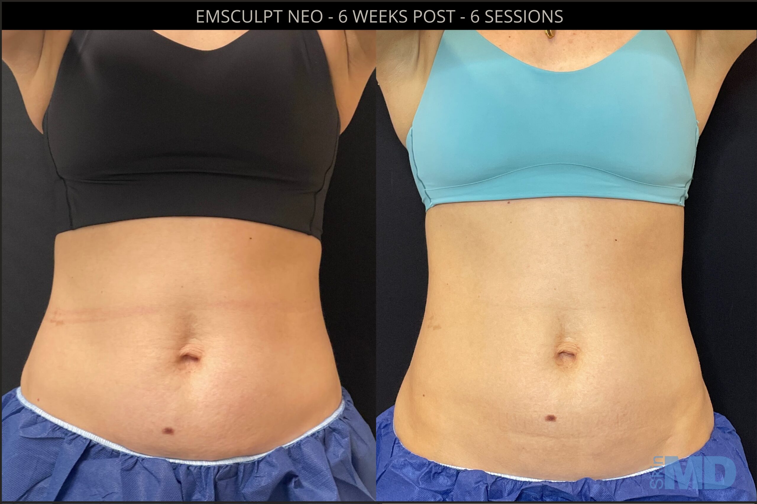 Before and after Emsculpt NEO results