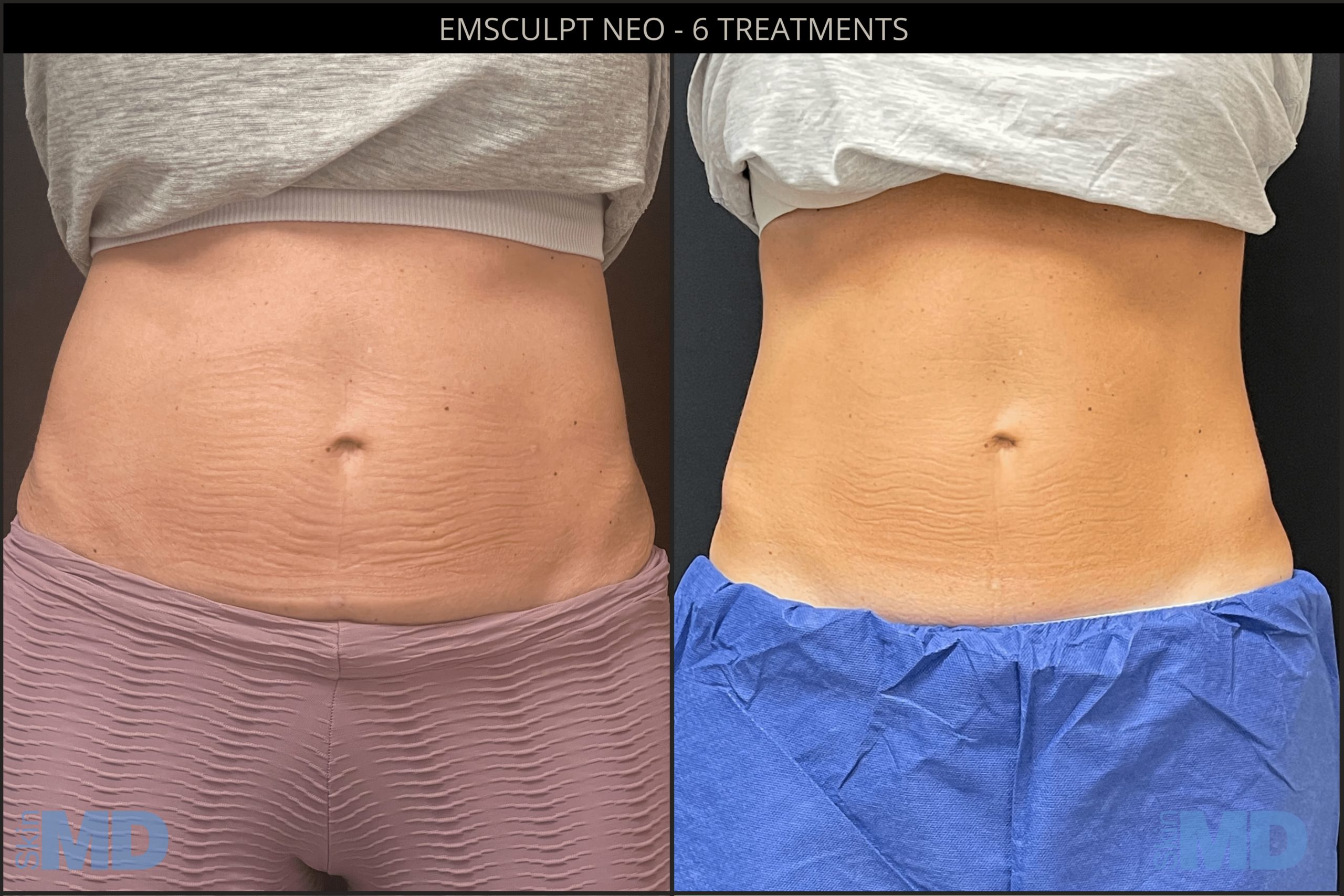 Does EmSculpt Help Men With Loose Skin?