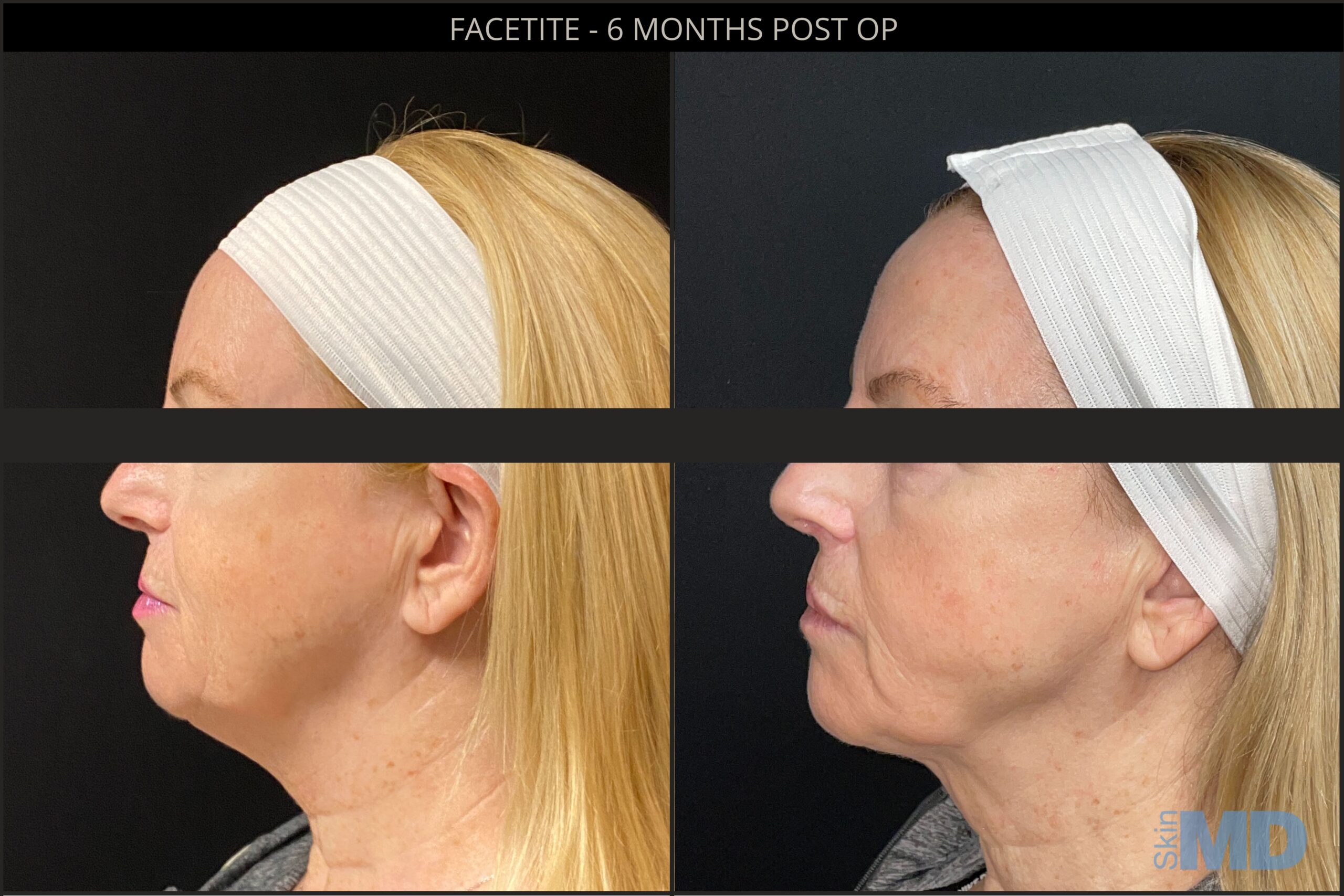 Before and after results for Facetite