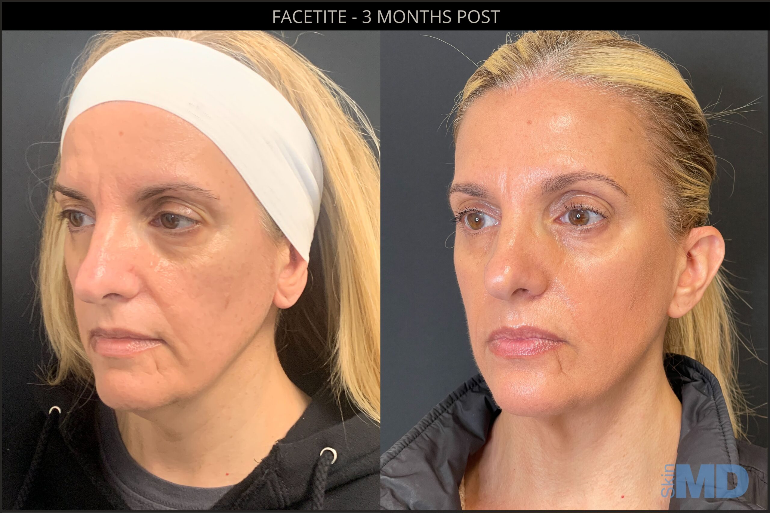 Before and after Facetite results