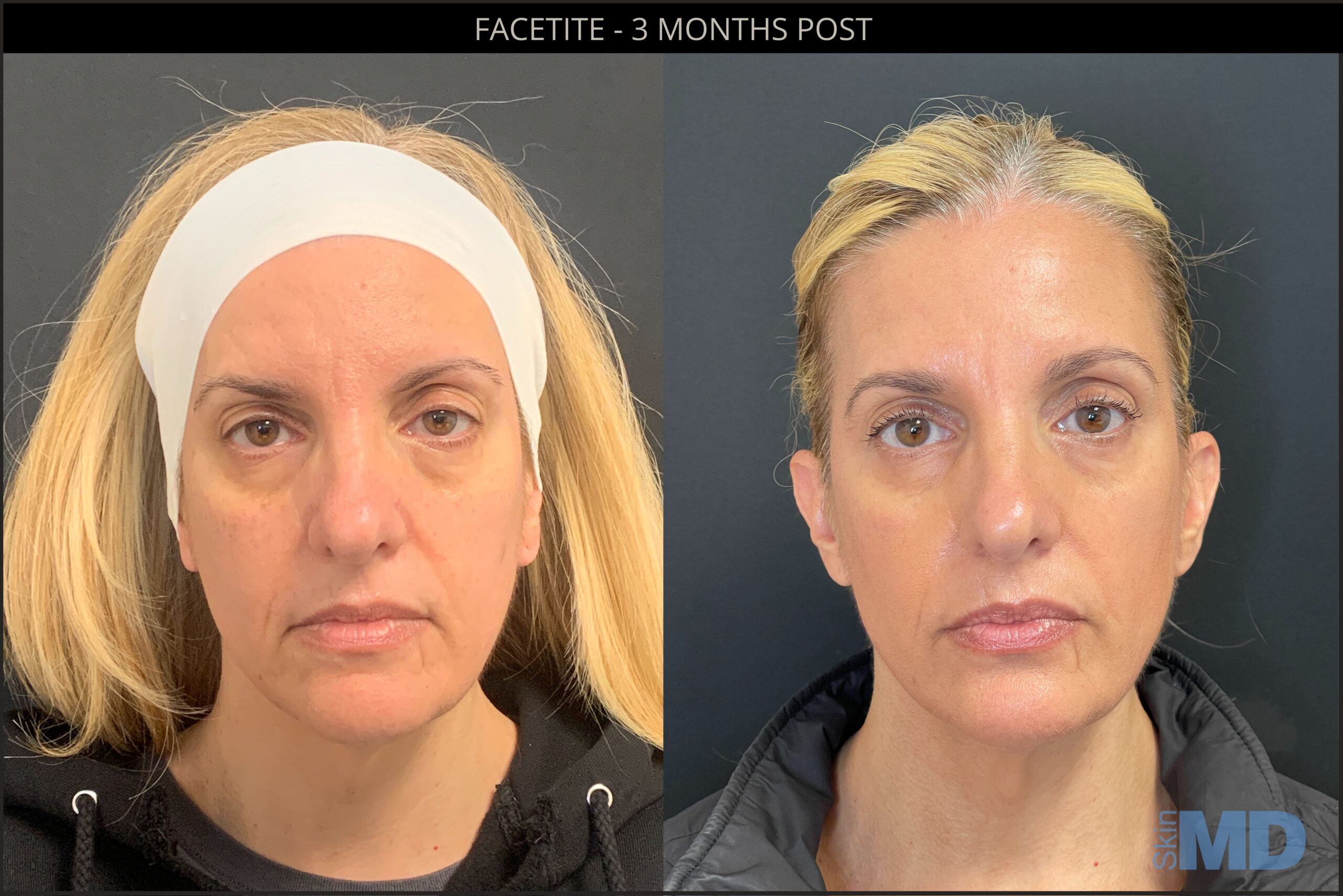 Before and after Facetite results
