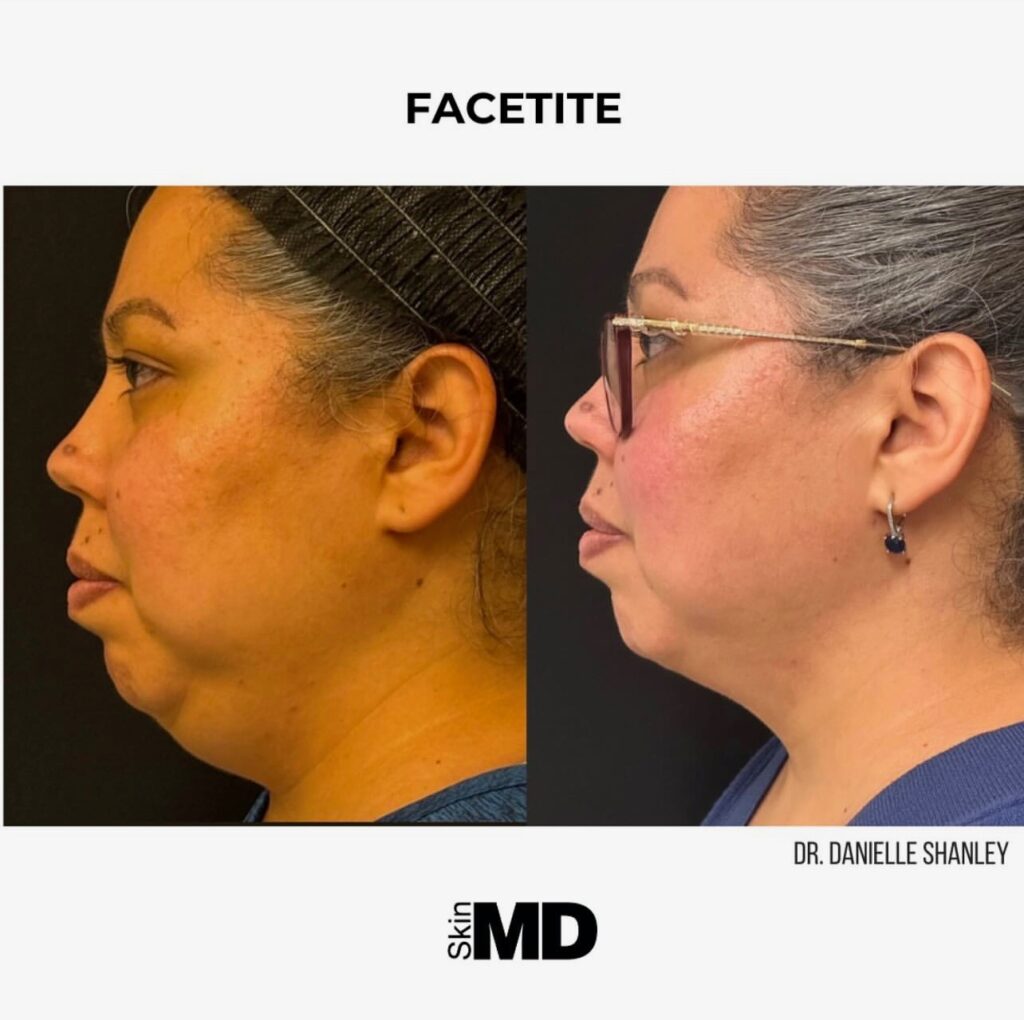 FaceTite