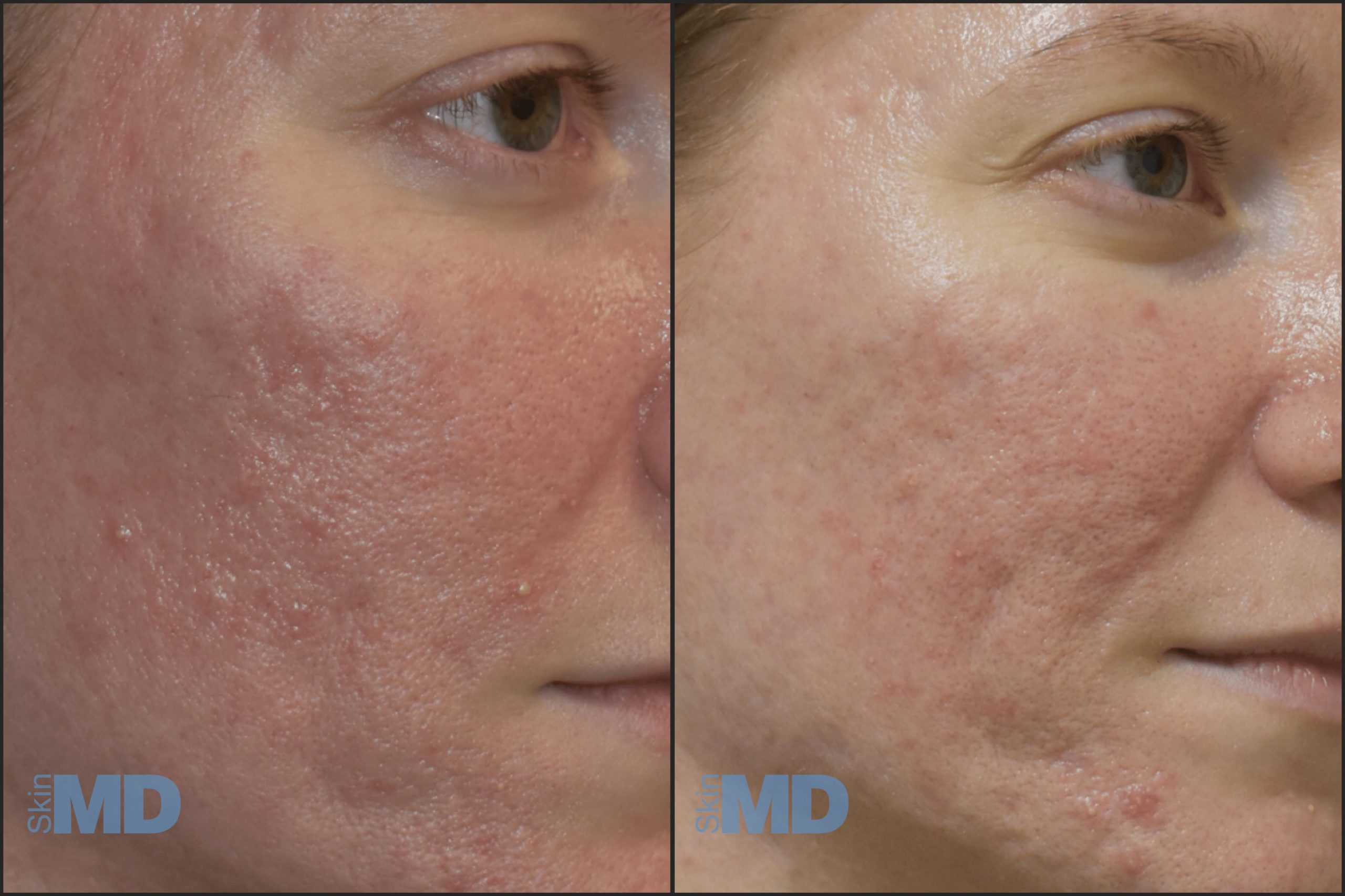 Before and after 1540 treatments