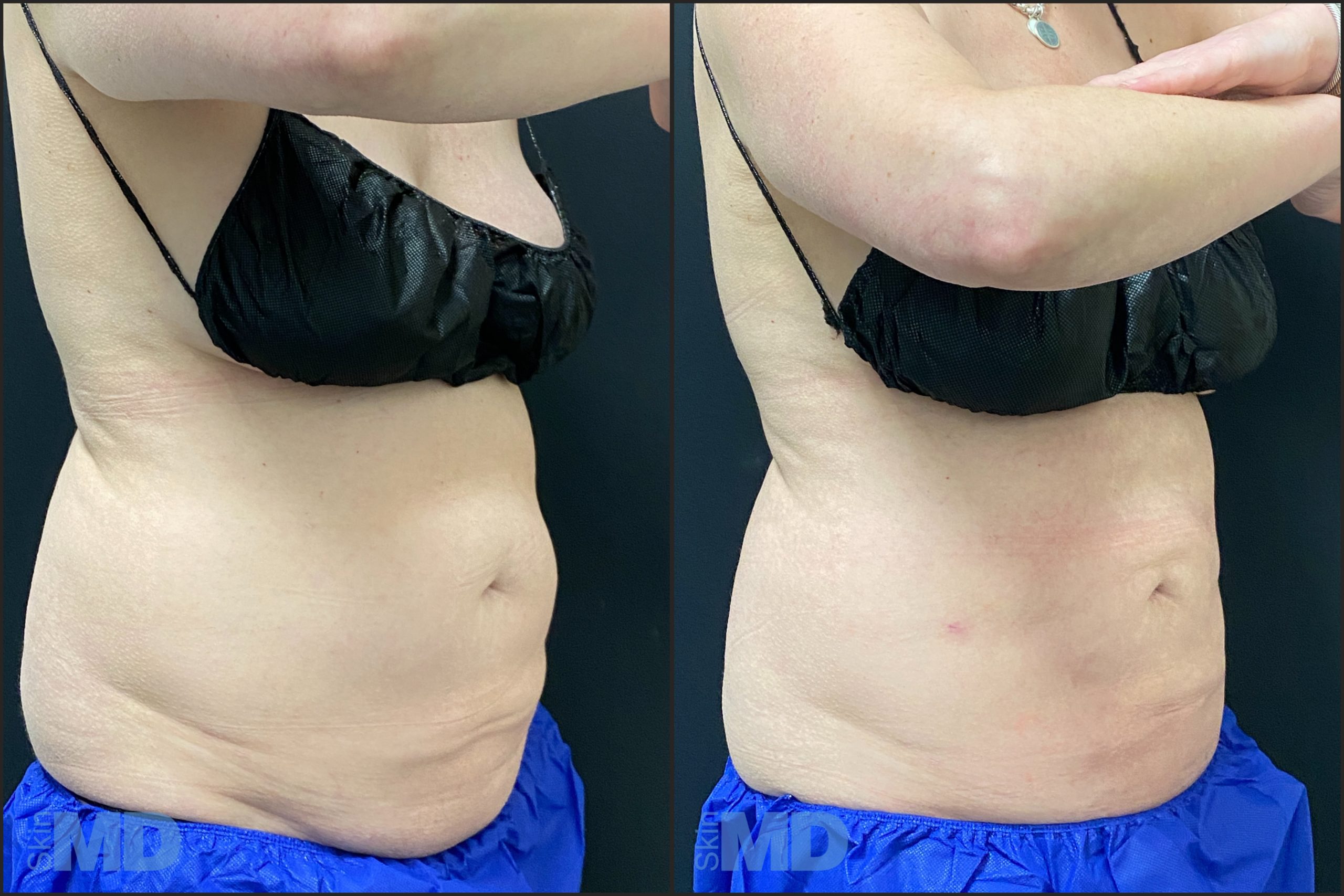 Before and after liposuction results