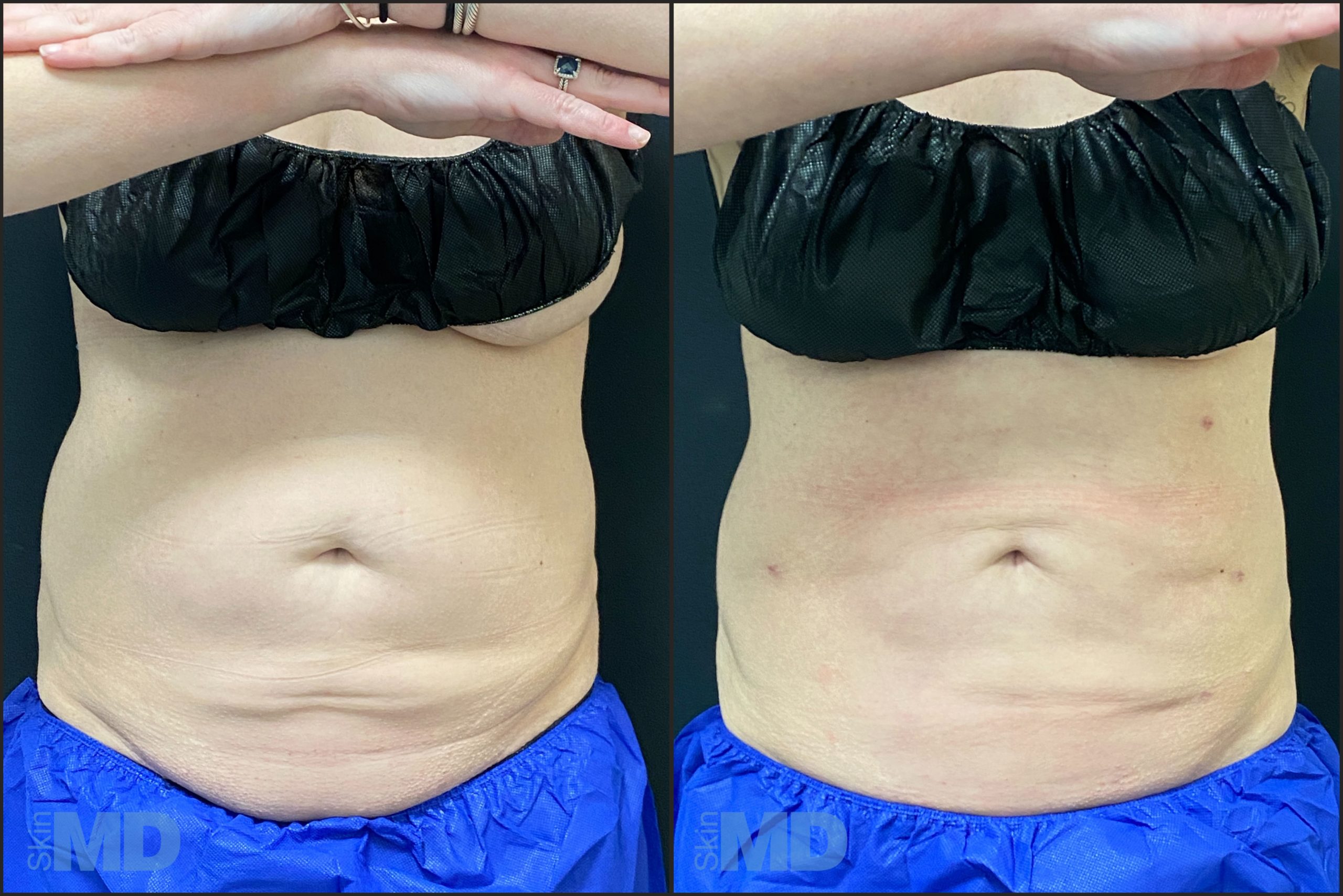 Affordable Liposuction Near Me? It's Possible! - Mid-Atlantic Skin