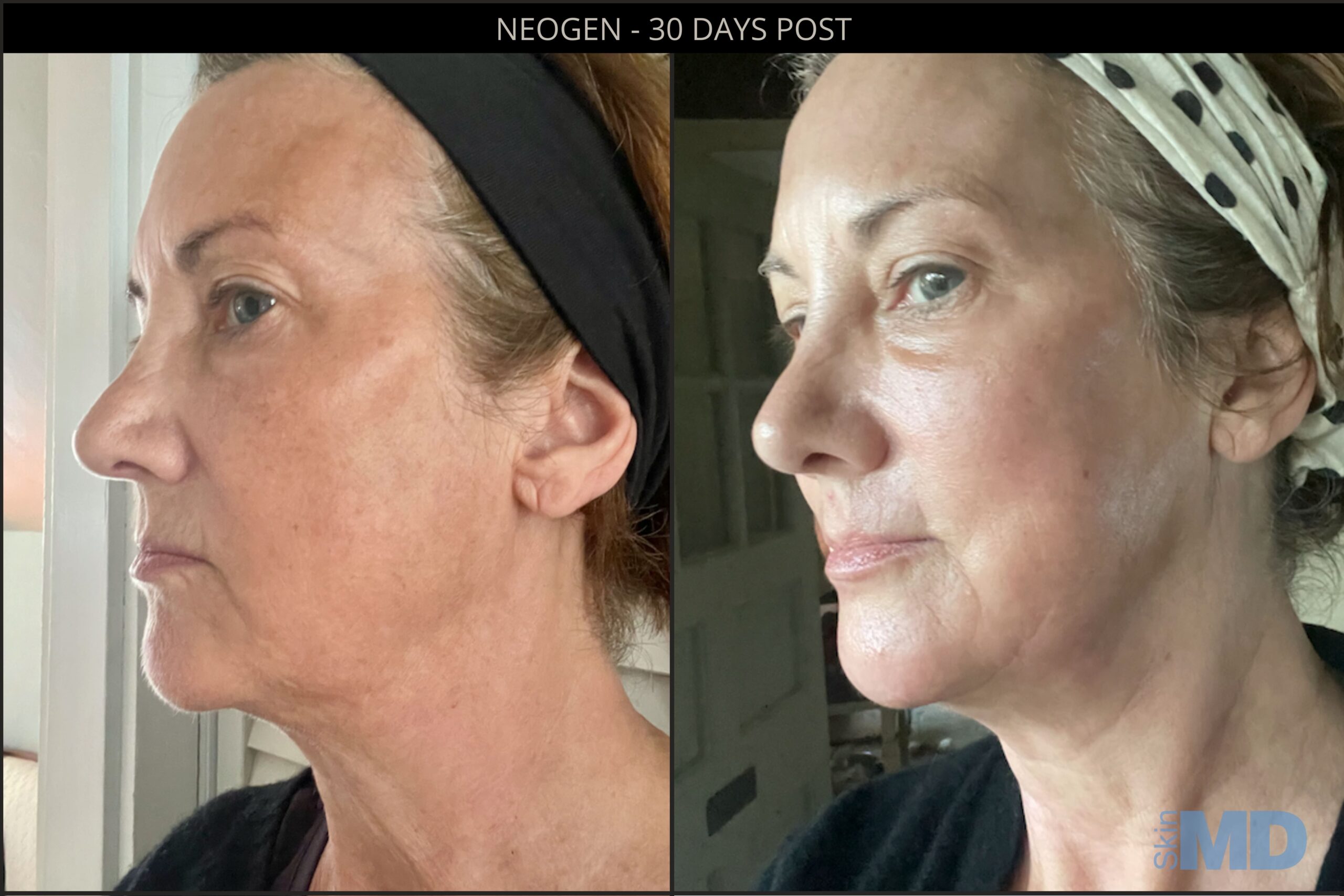 Before and after NeoGen results
