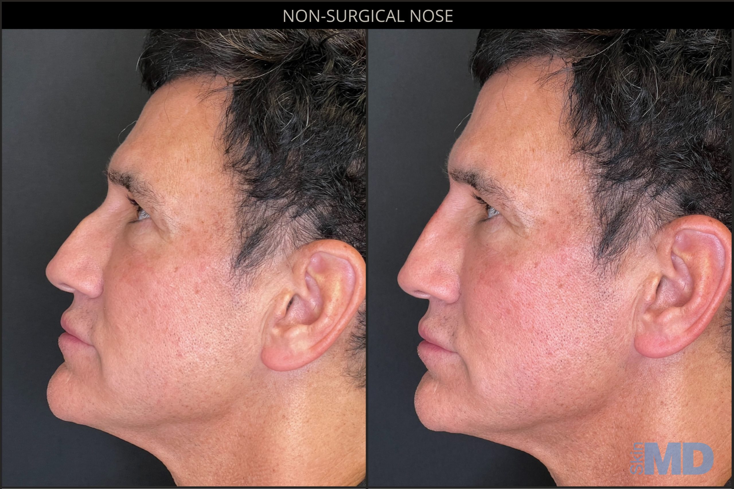 Before and after non-surgical nose treatment results