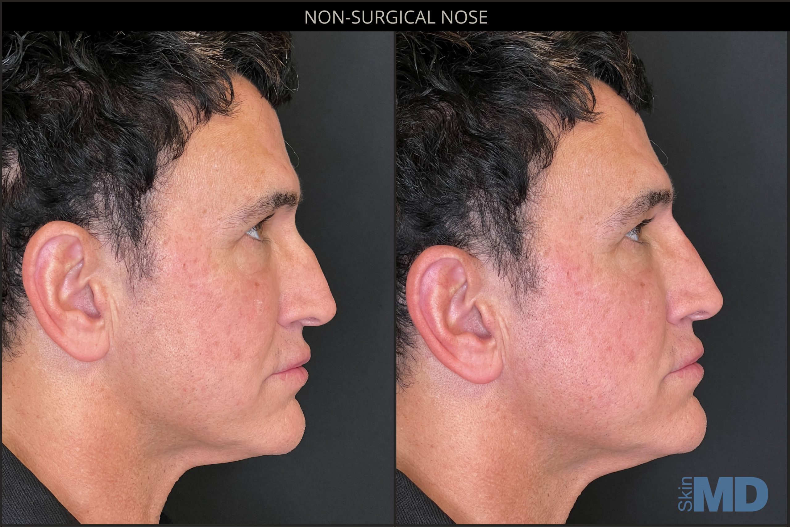 Before and after non-surgical nose treatment results