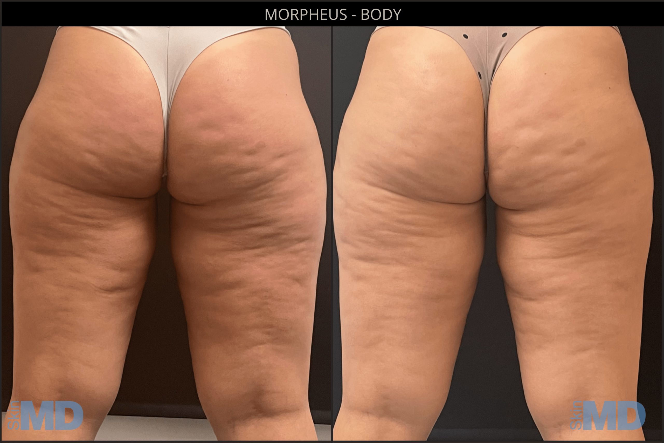Before and after Morpheus8 results