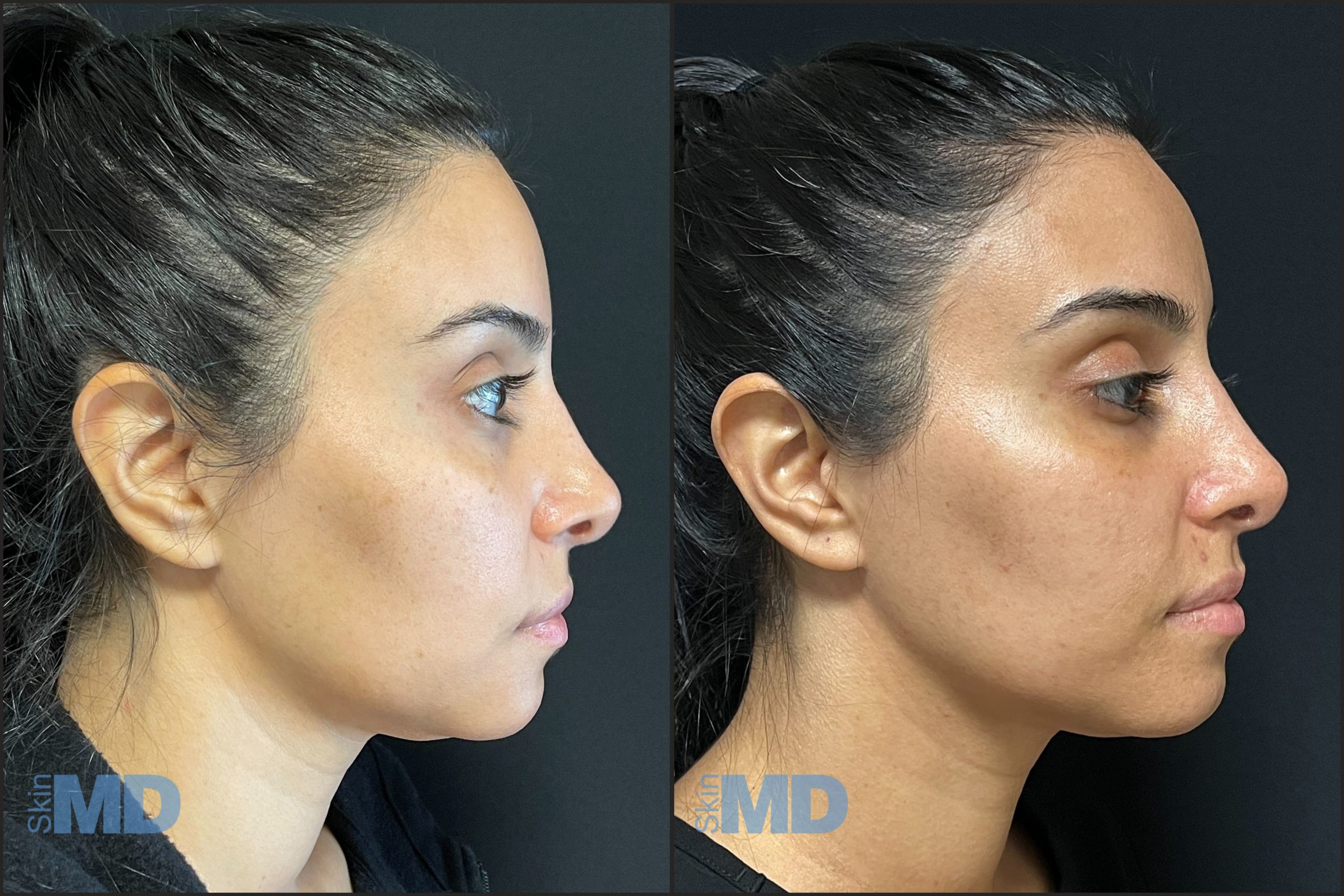 Before and after Morpheus results