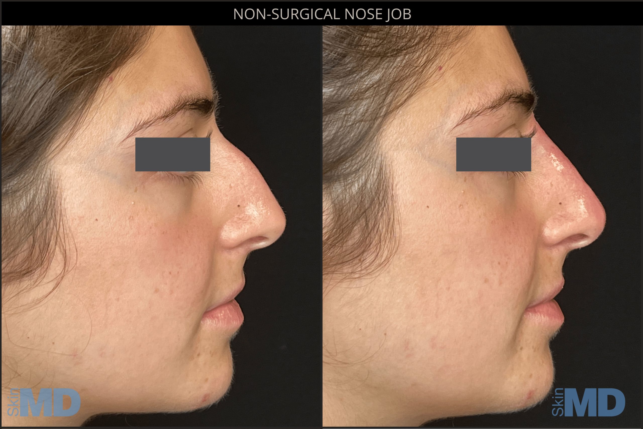 Before and after non-surgical nose job results