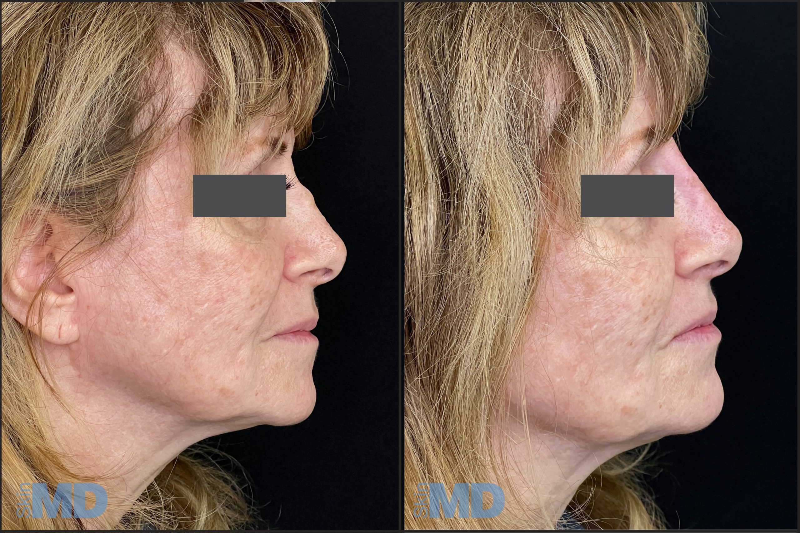 Before and after non-surgical nose job results