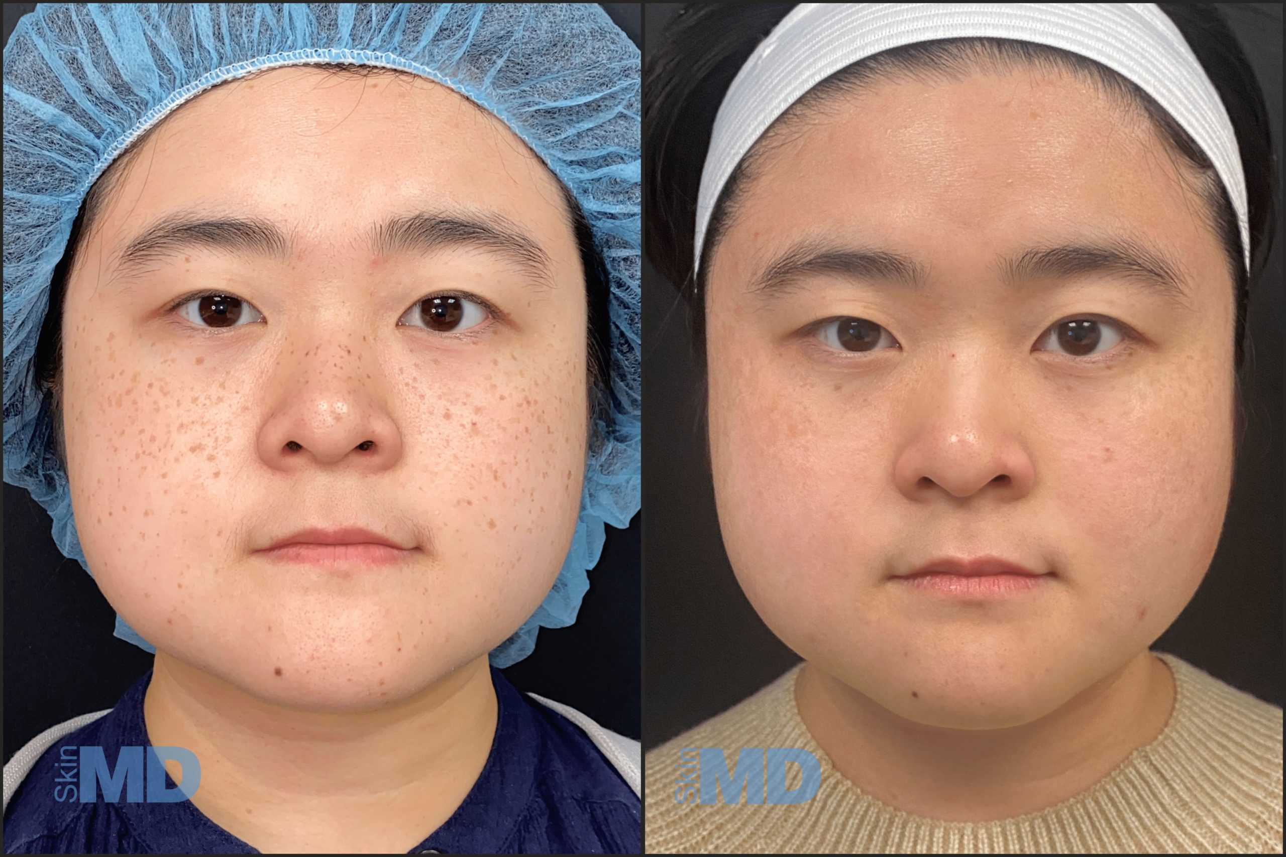 Before and after Pico Genesis results