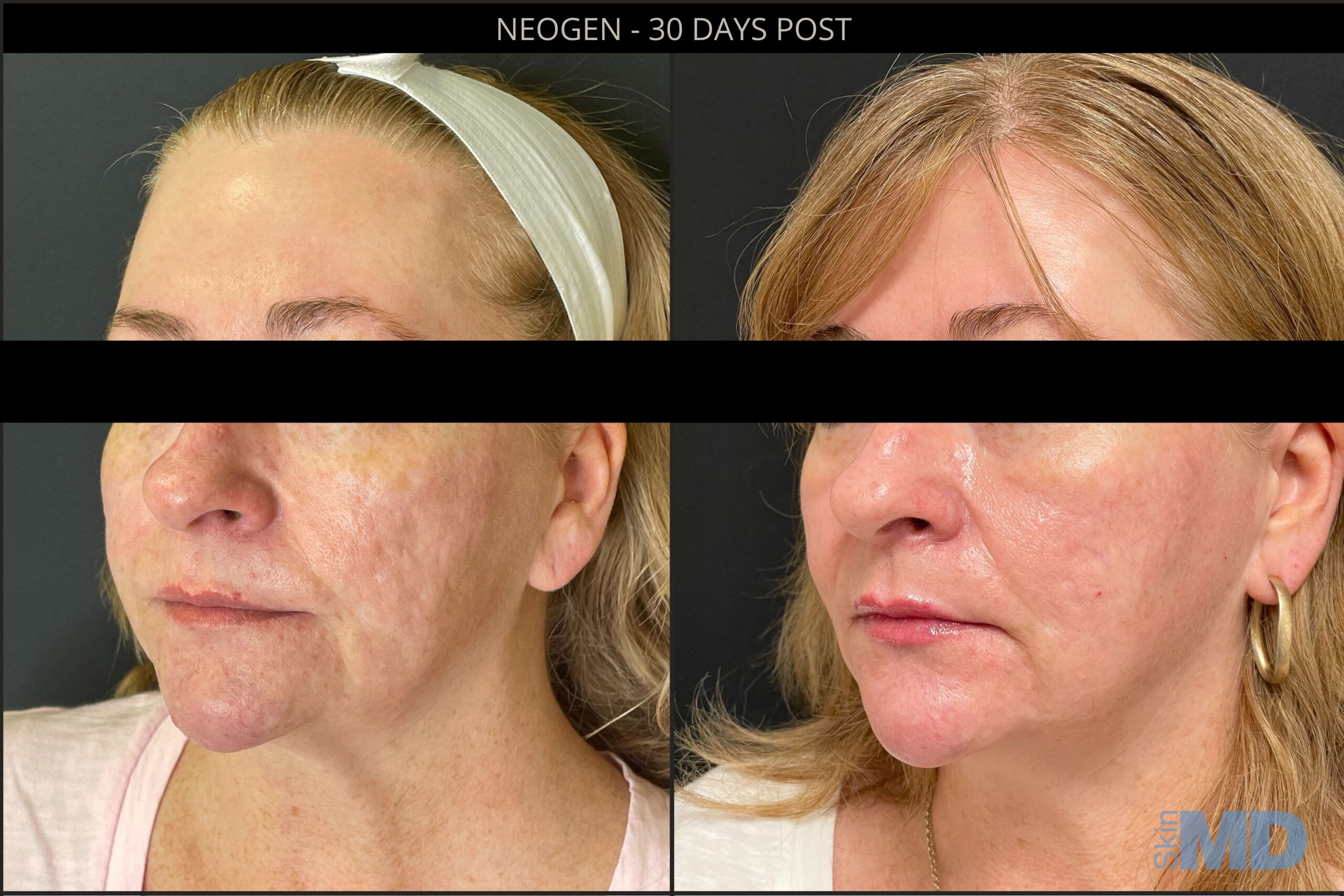 Before and after NeoGen results