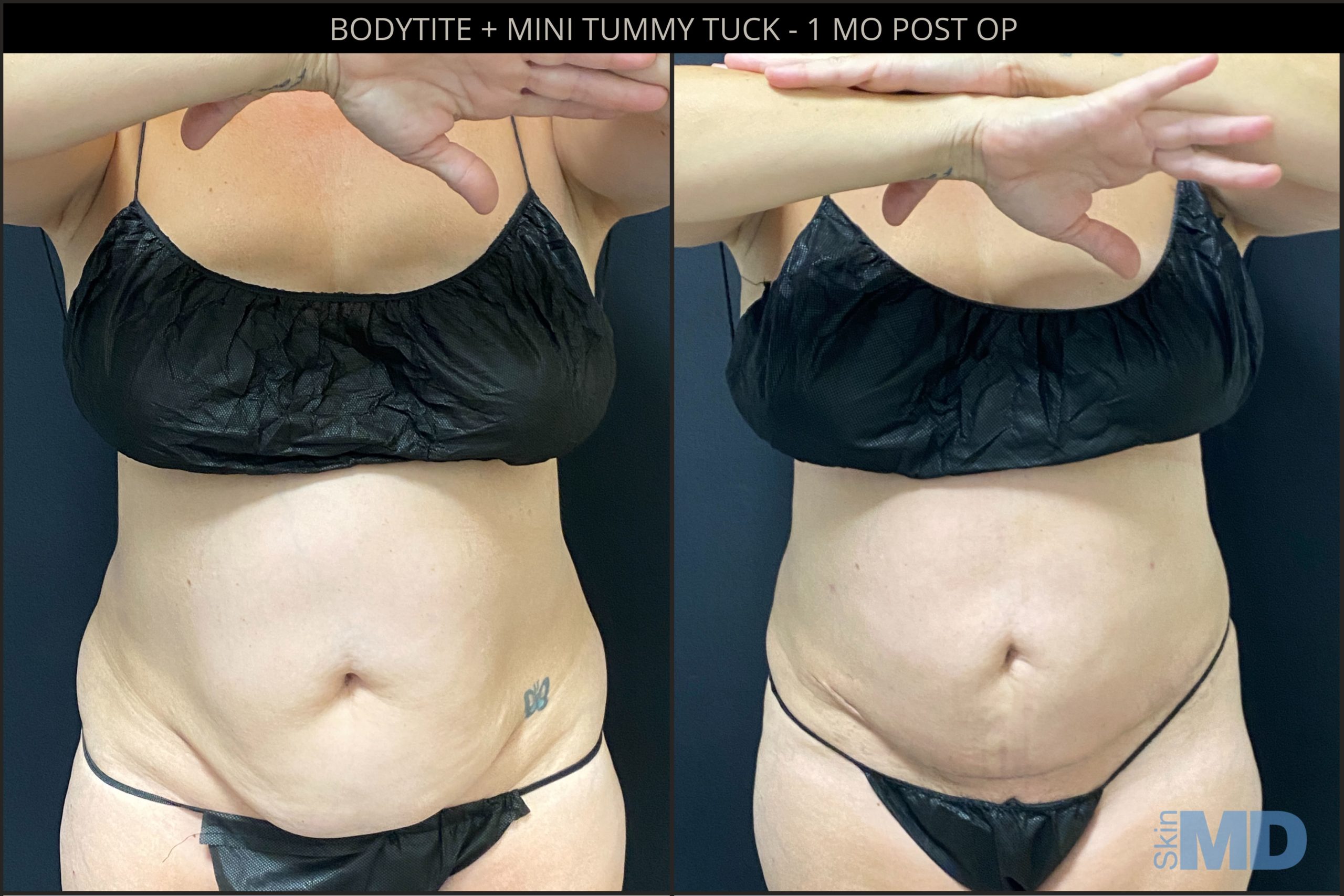 Before and after tummy tuck and BodyTite results