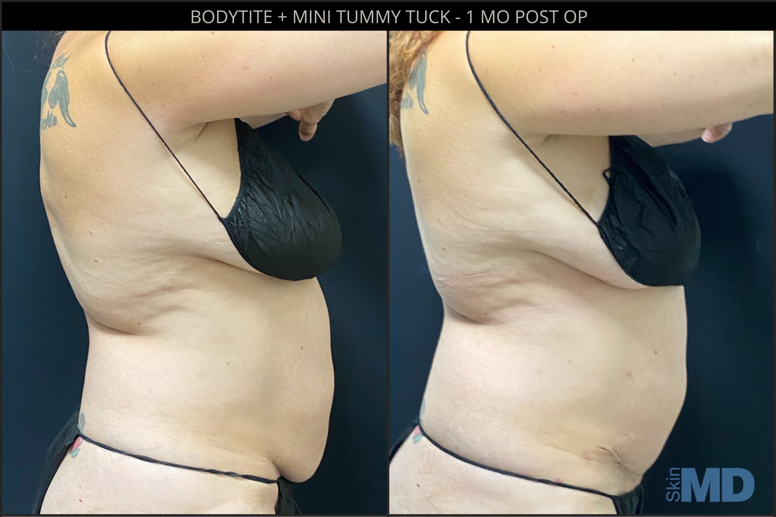 Before and after tummy tuck and BodyTite results