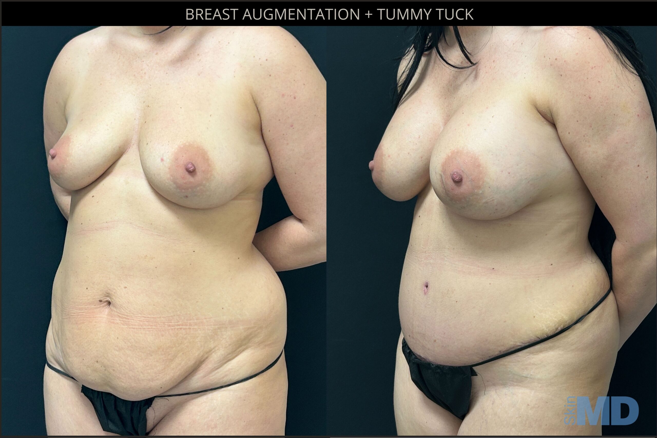 Before and after tummy tuck and breast augmentation results